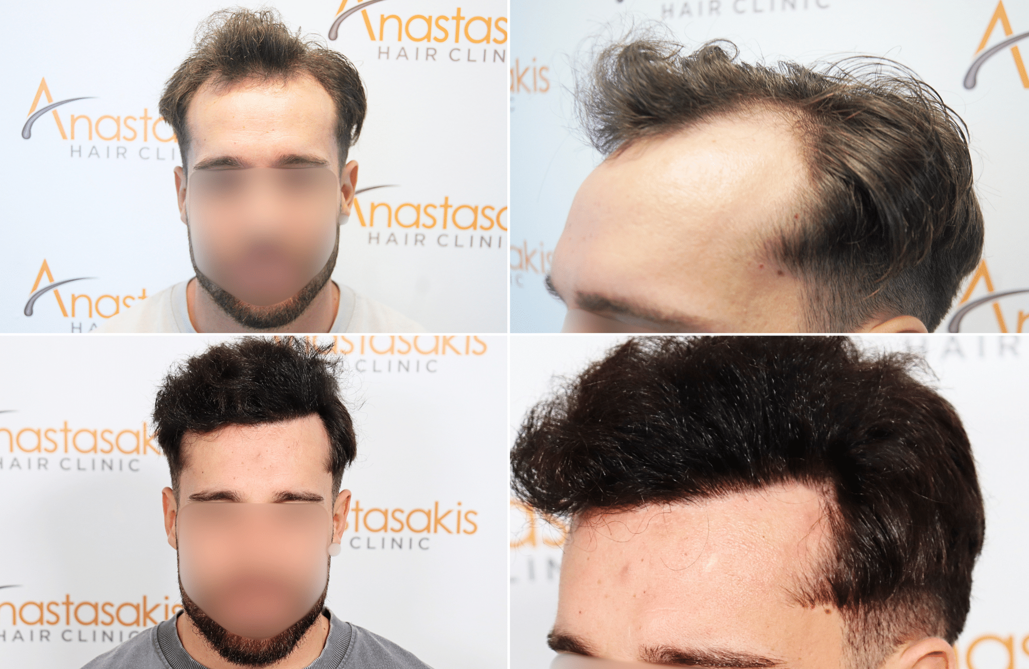 https://www.anastasakishairclinic.gr/portfolio/apotelesma-metamosxefsis-mallion-anastasakis-hair-clinic-193/