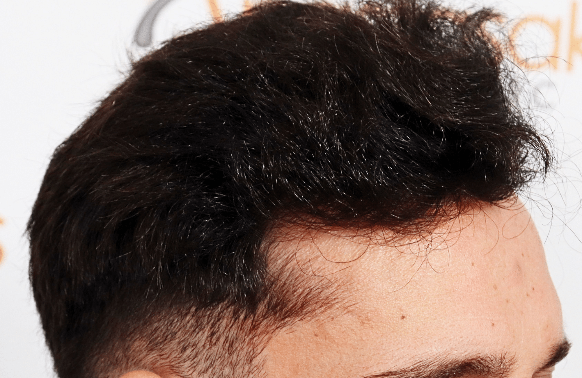 hair transplant result 2500 fus stage 3 thick 30yo