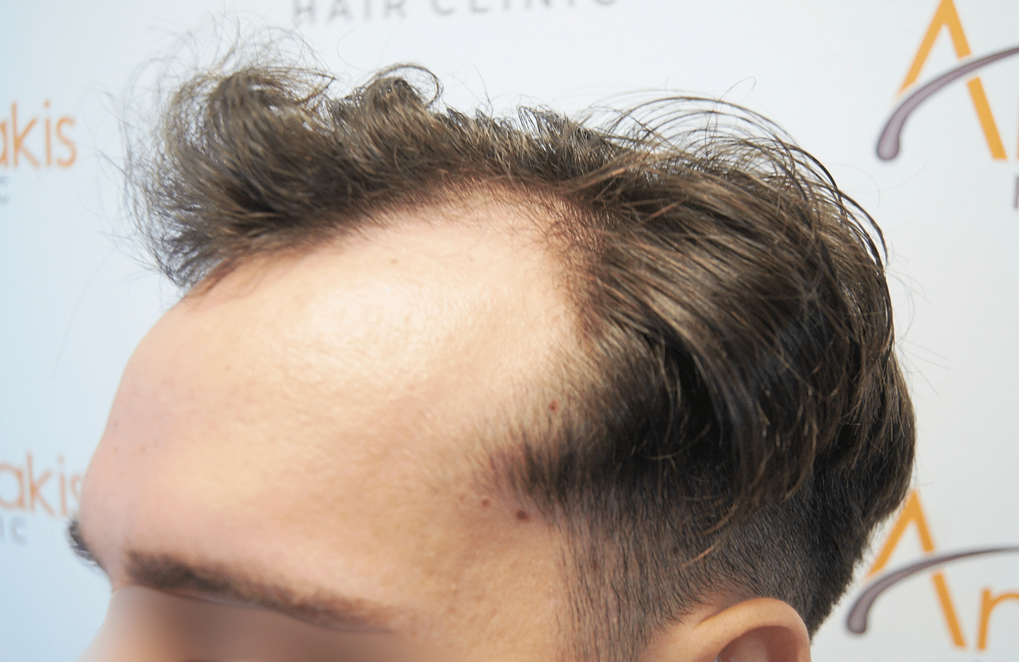 hair transplant result 2500 fus stage 3 thick 30yo