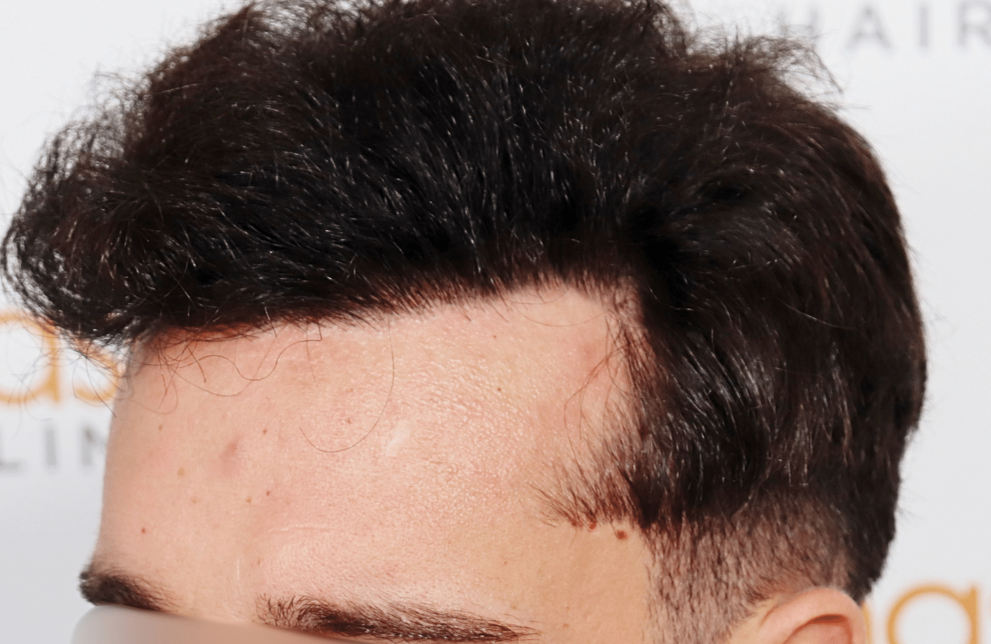 hair transplant result 2500 fus stage 3 thick 30yo