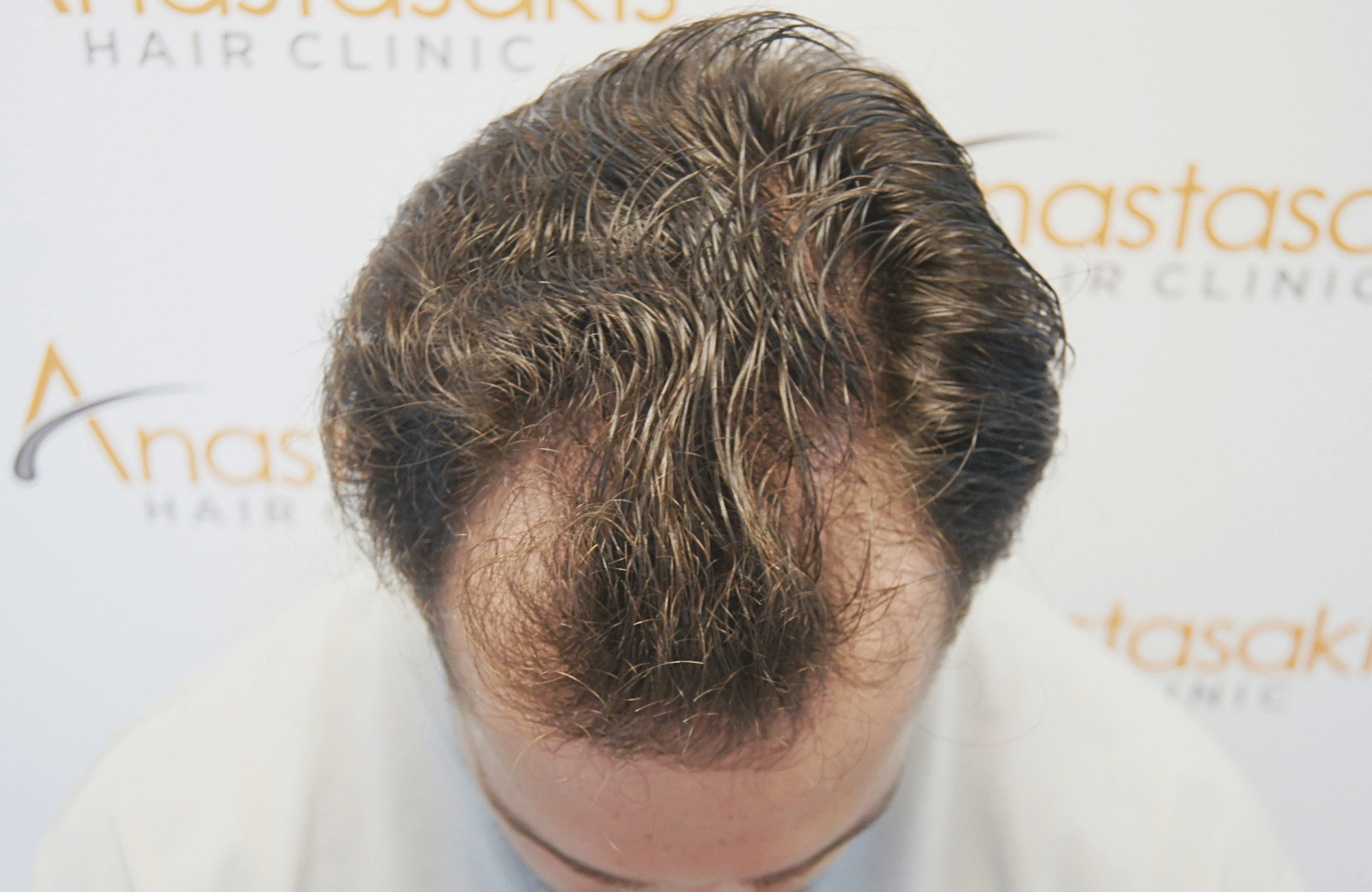 hair transplant result 2500 fus stage 3 thick 30yo