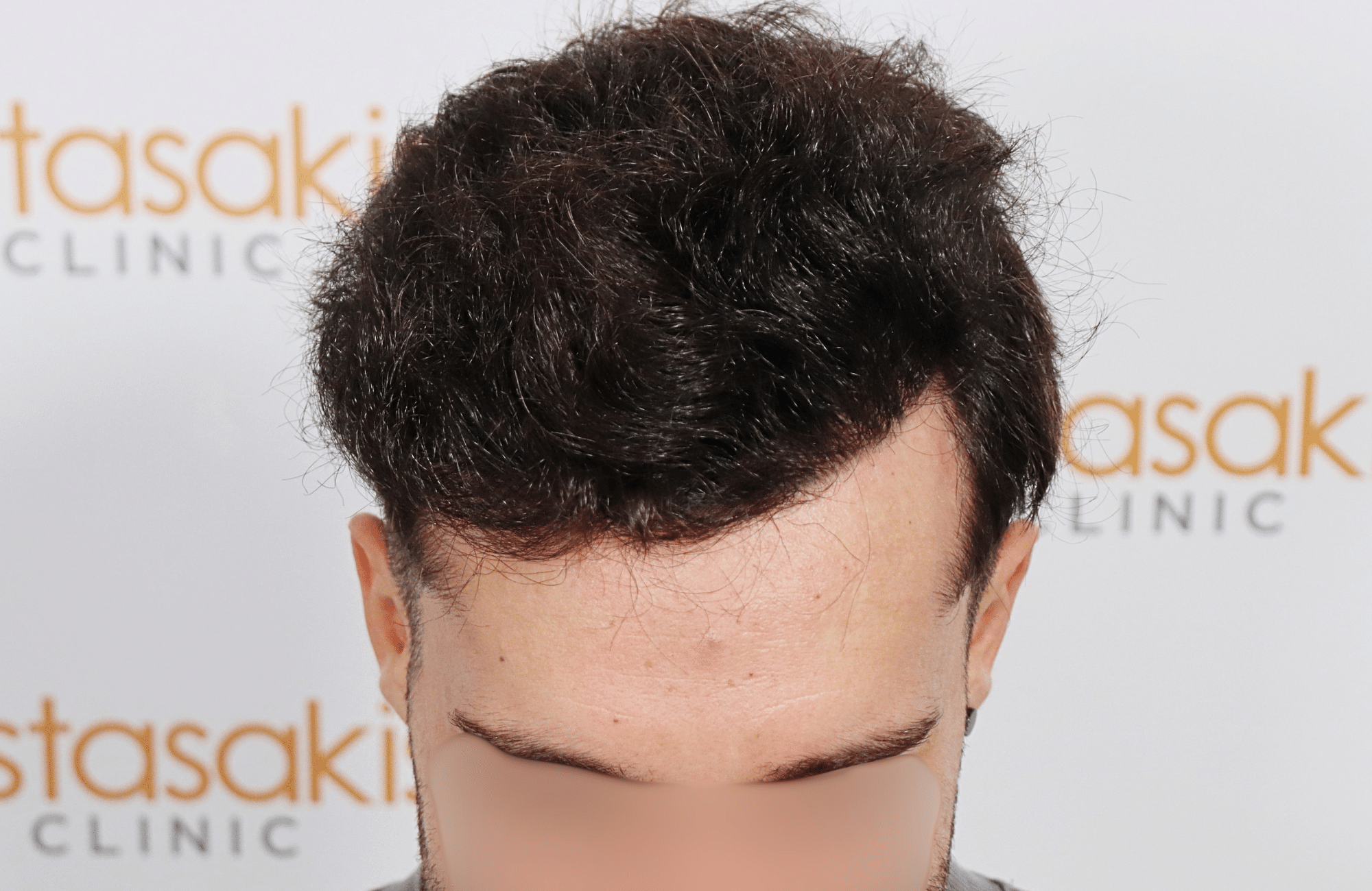 hair transplant result 2500 fus stage 3 thick 30yo
