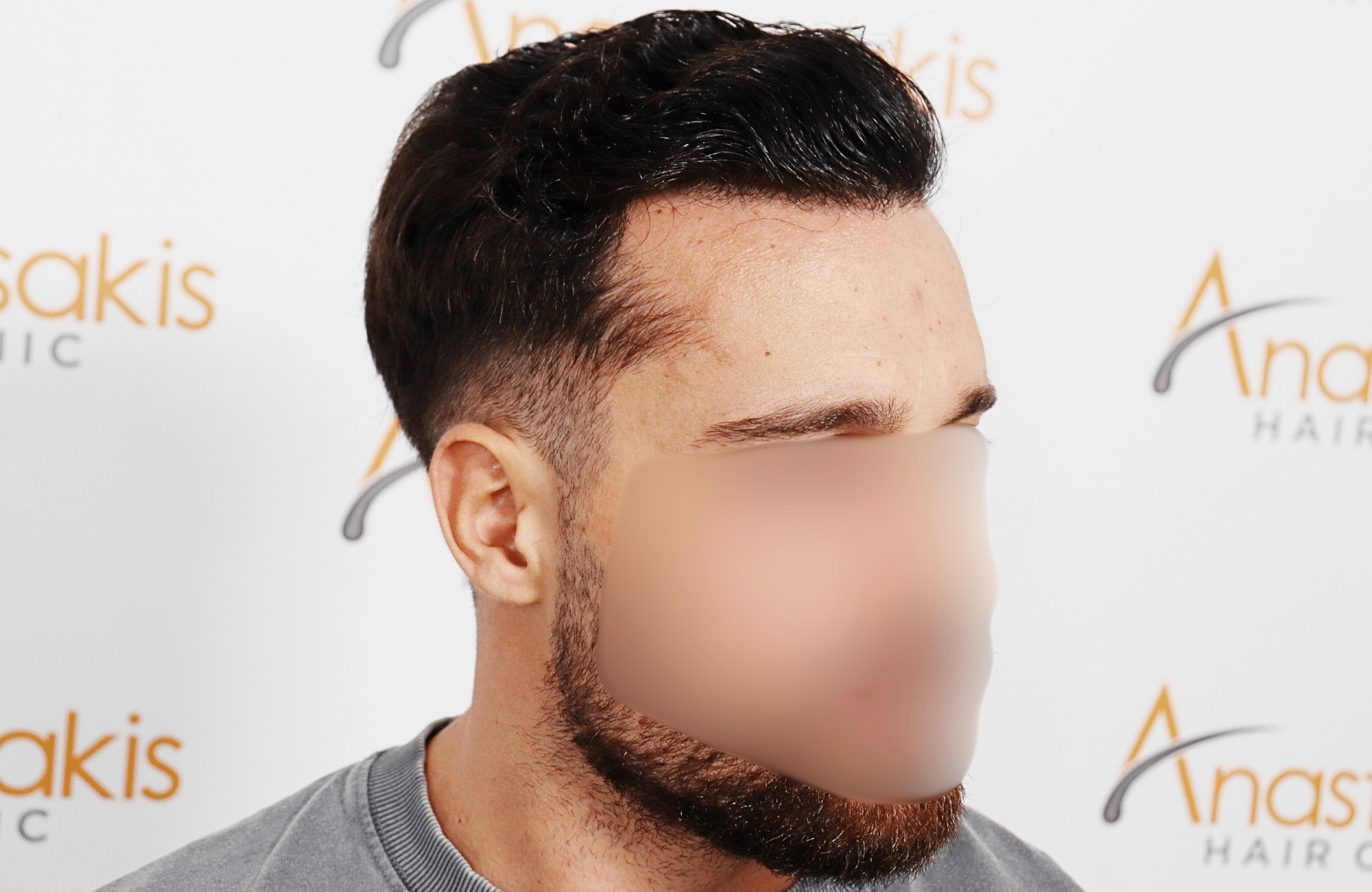 hair transplant result 2500 fus stage 3 thick 30yo