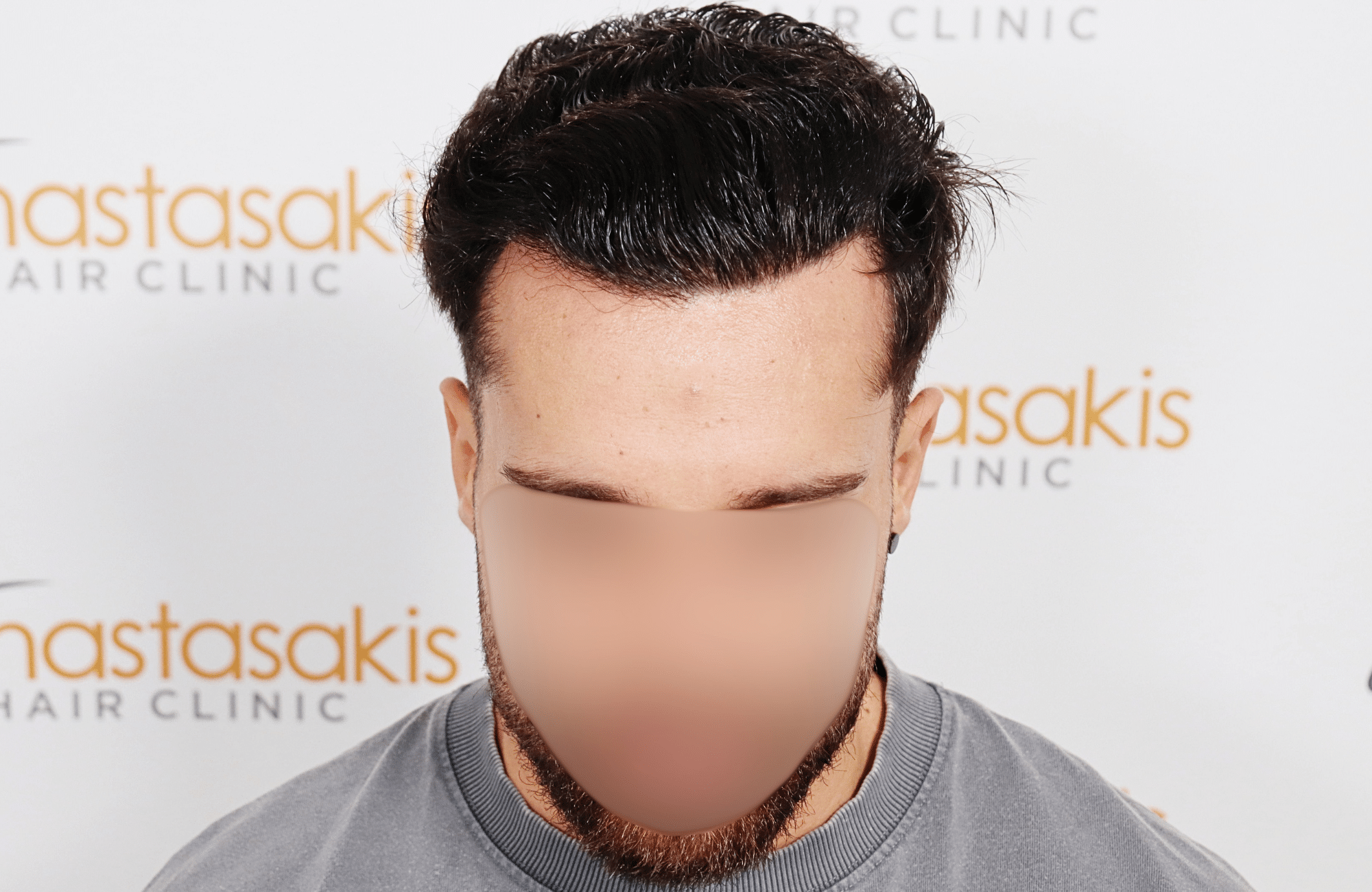 hair transplant result 2500 fus stage 3 thick 30yo