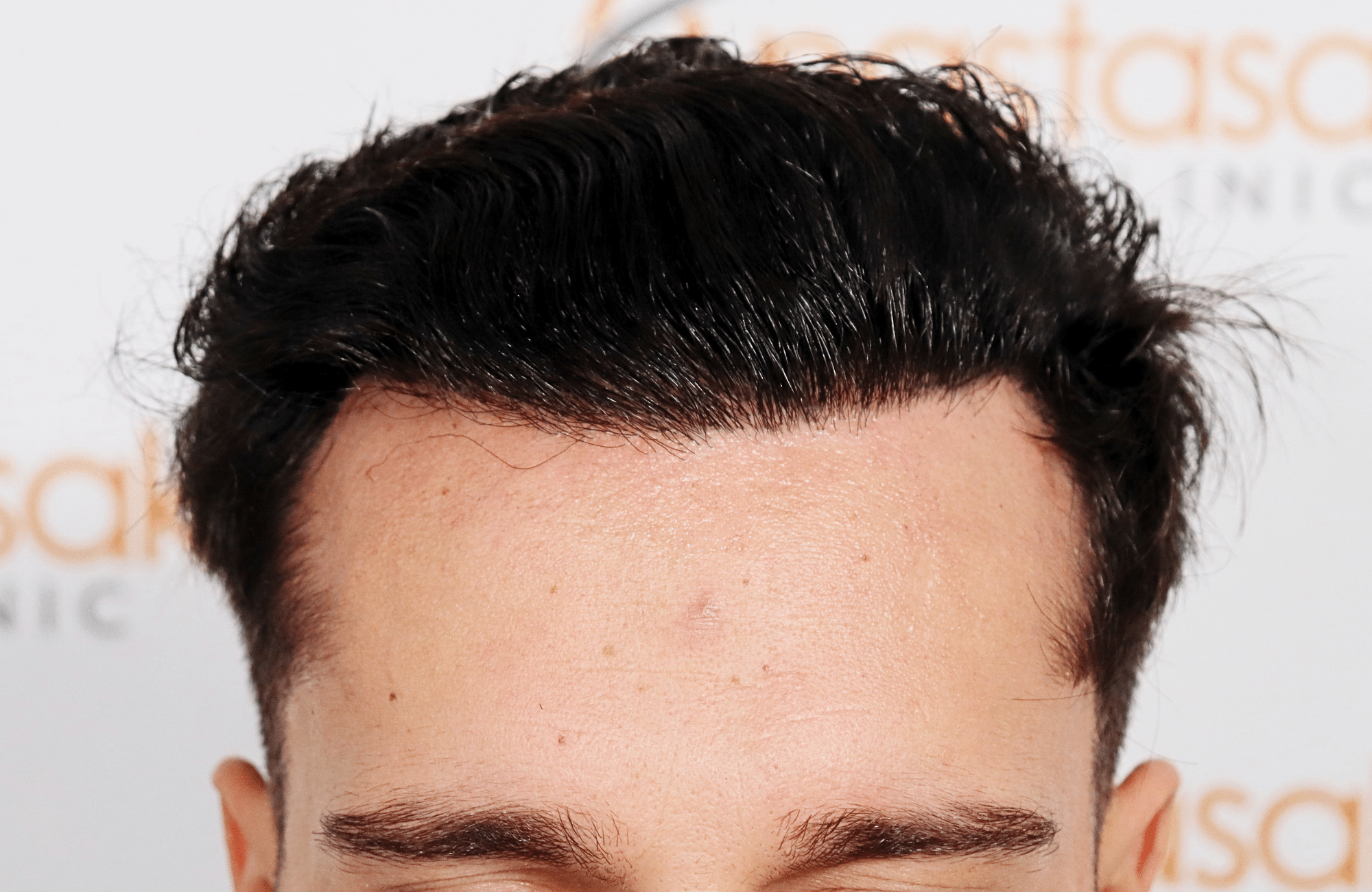 hair transplant result 2500 fus stage 3 thick 30yo
