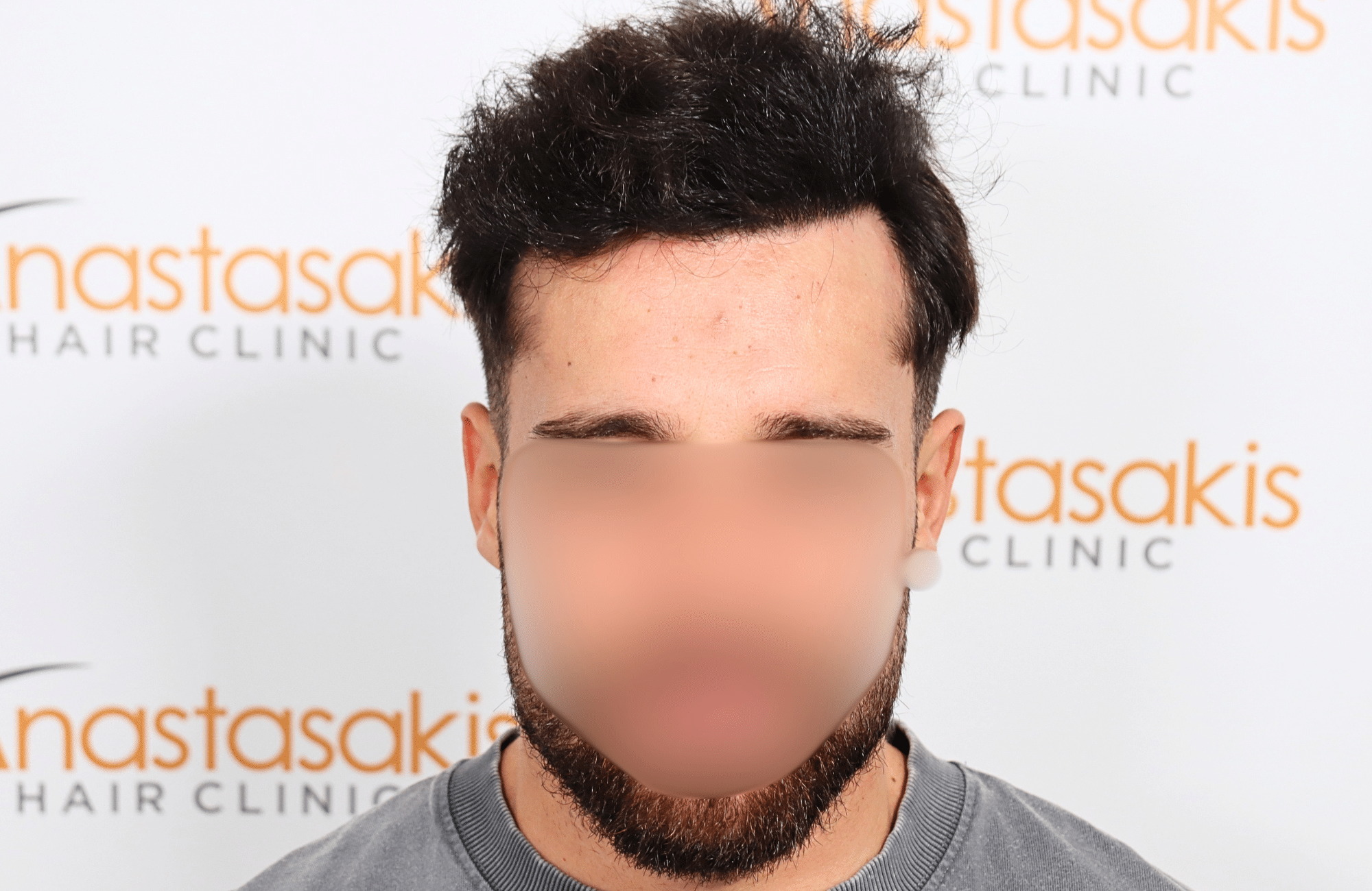hair transplant result 2500 fus stage 3 thick 30yo