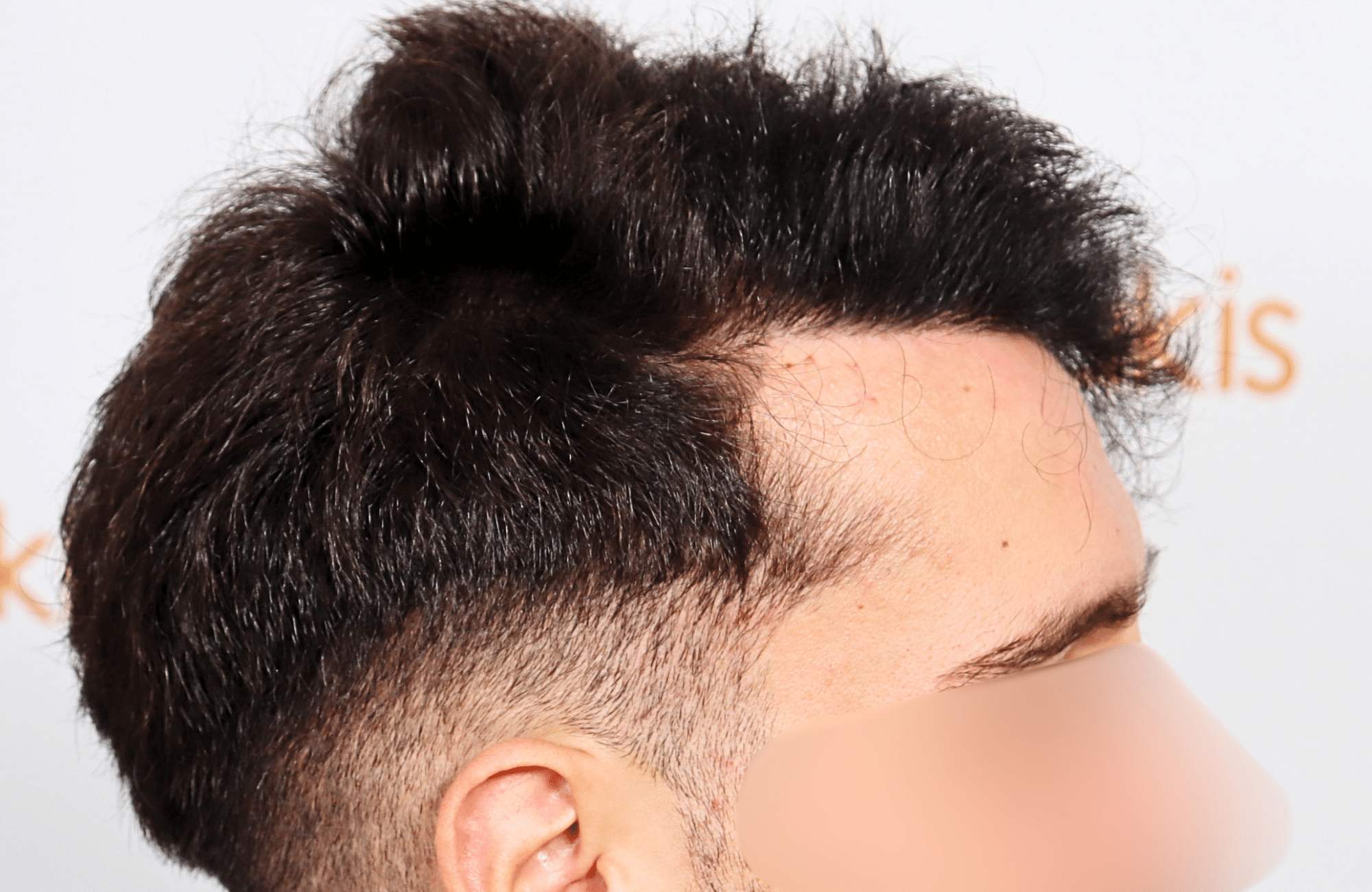 hair transplant result 2500 fus stage 3 thick 30yo