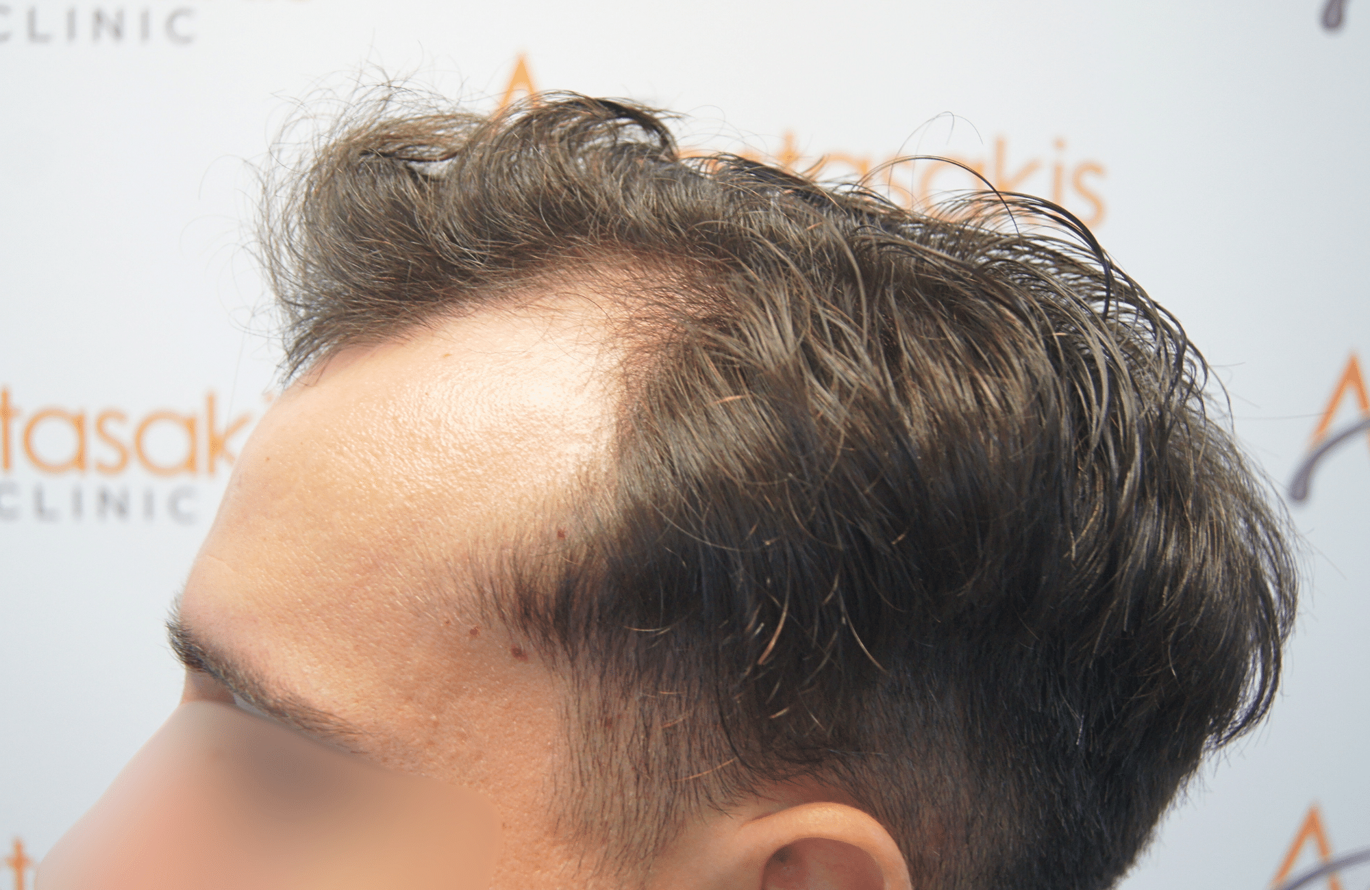 hair transplant result 2500 fus stage 3 thick 30yo