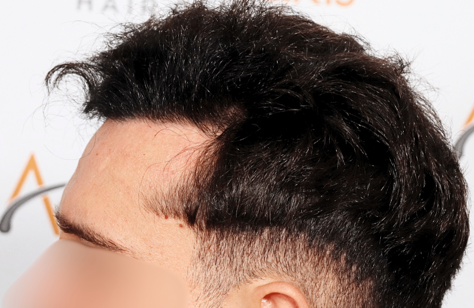 hair transplant result 2500 fus stage 3 thick 30yo