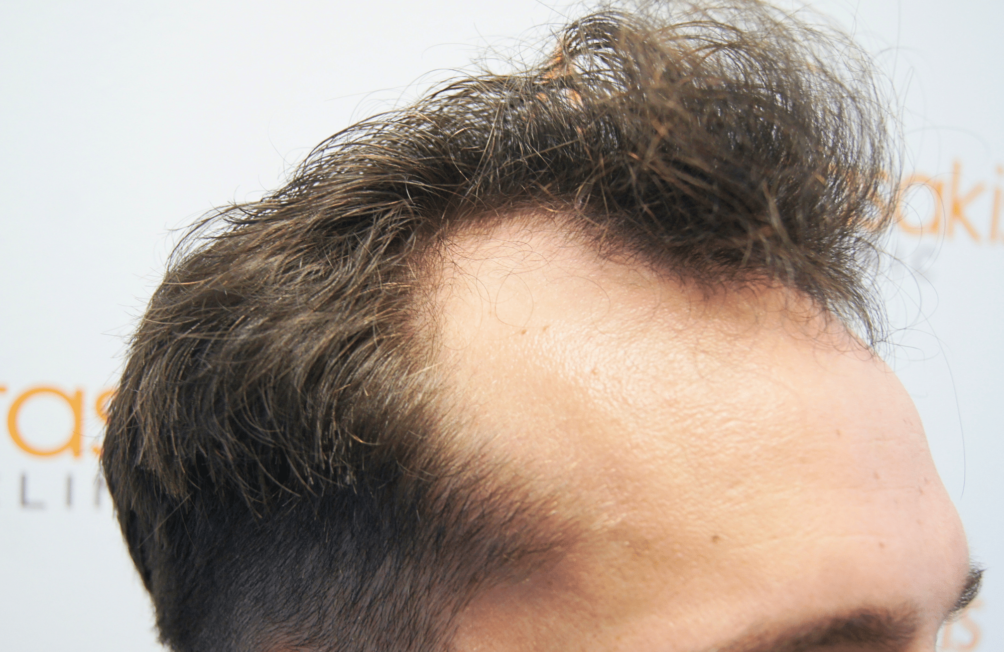 hair transplant result 2500 fus stage 3 thick 30yo
