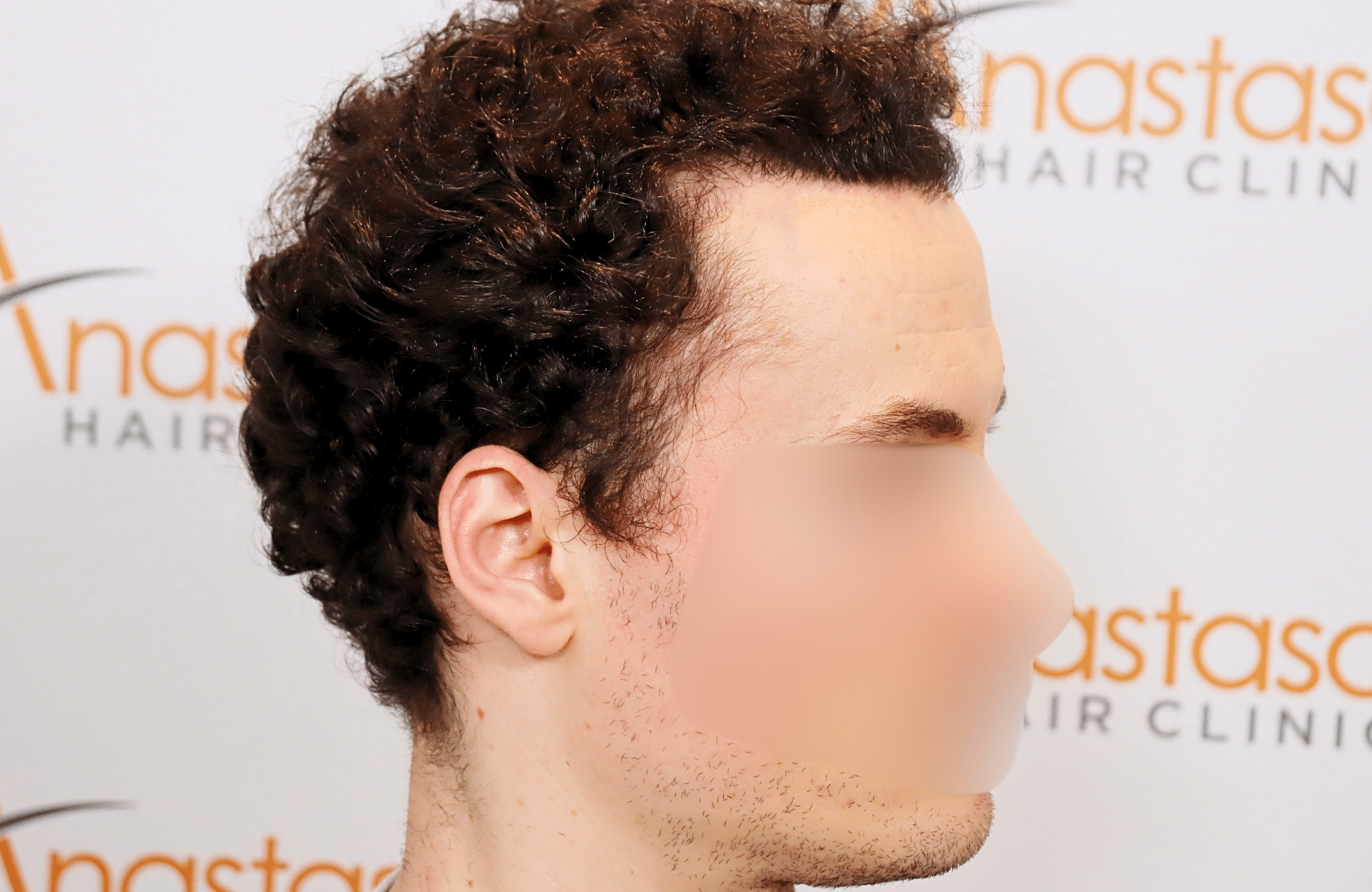 hair transplant result 2500 fus thick (10)