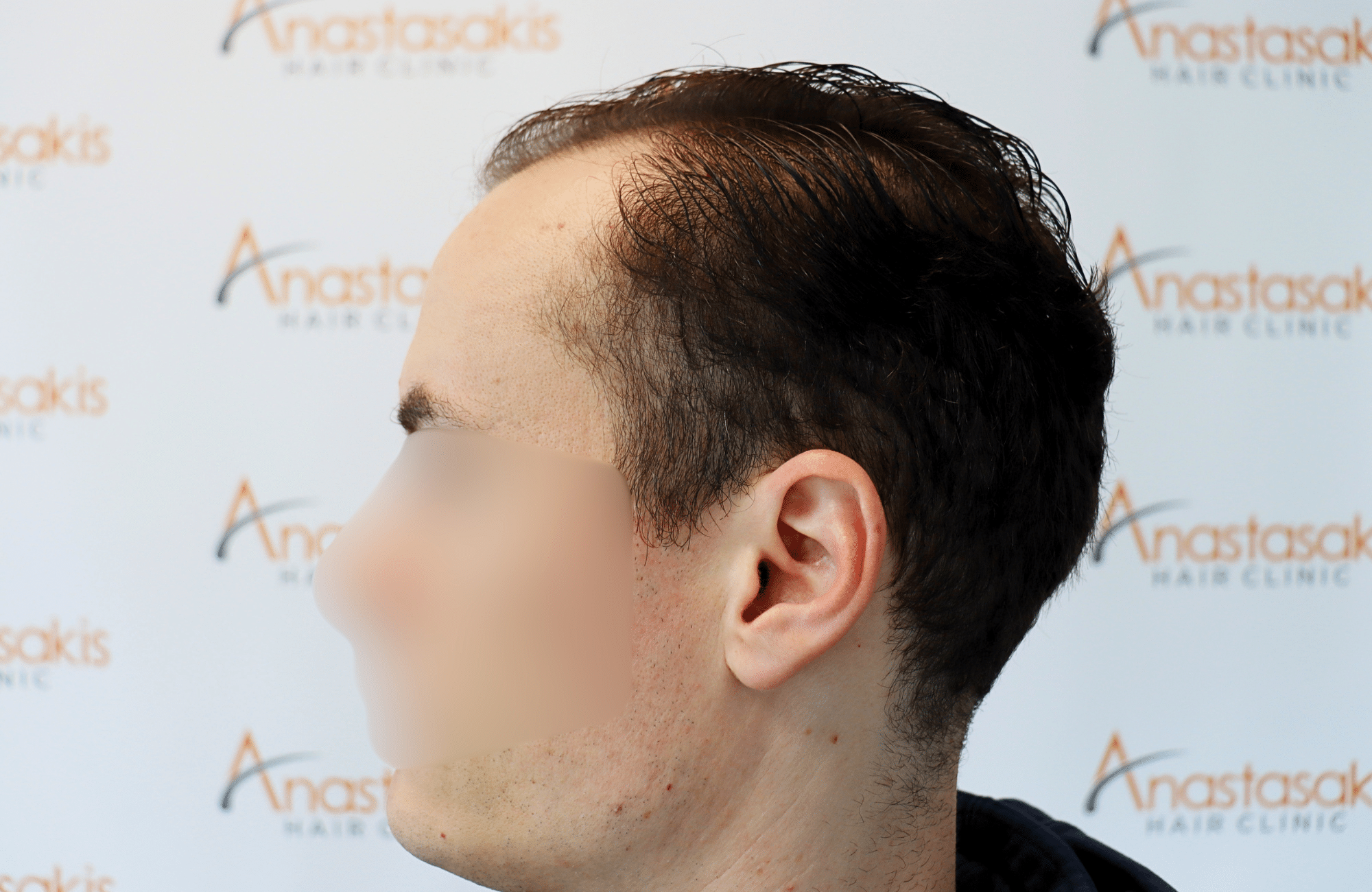 hair transplant result 2500 fus thick (11)