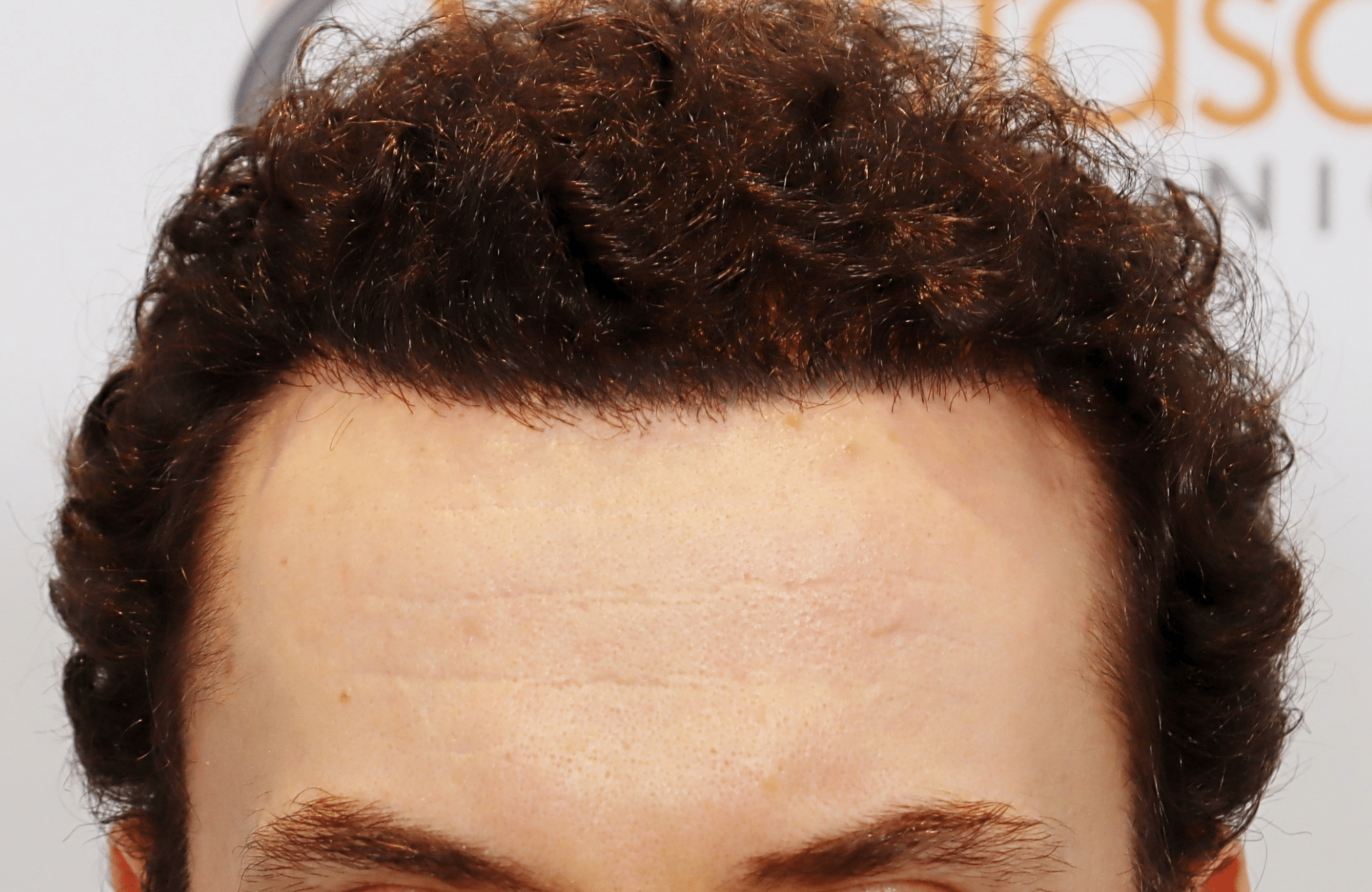 hair transplant result 2500 fus thick (14)
