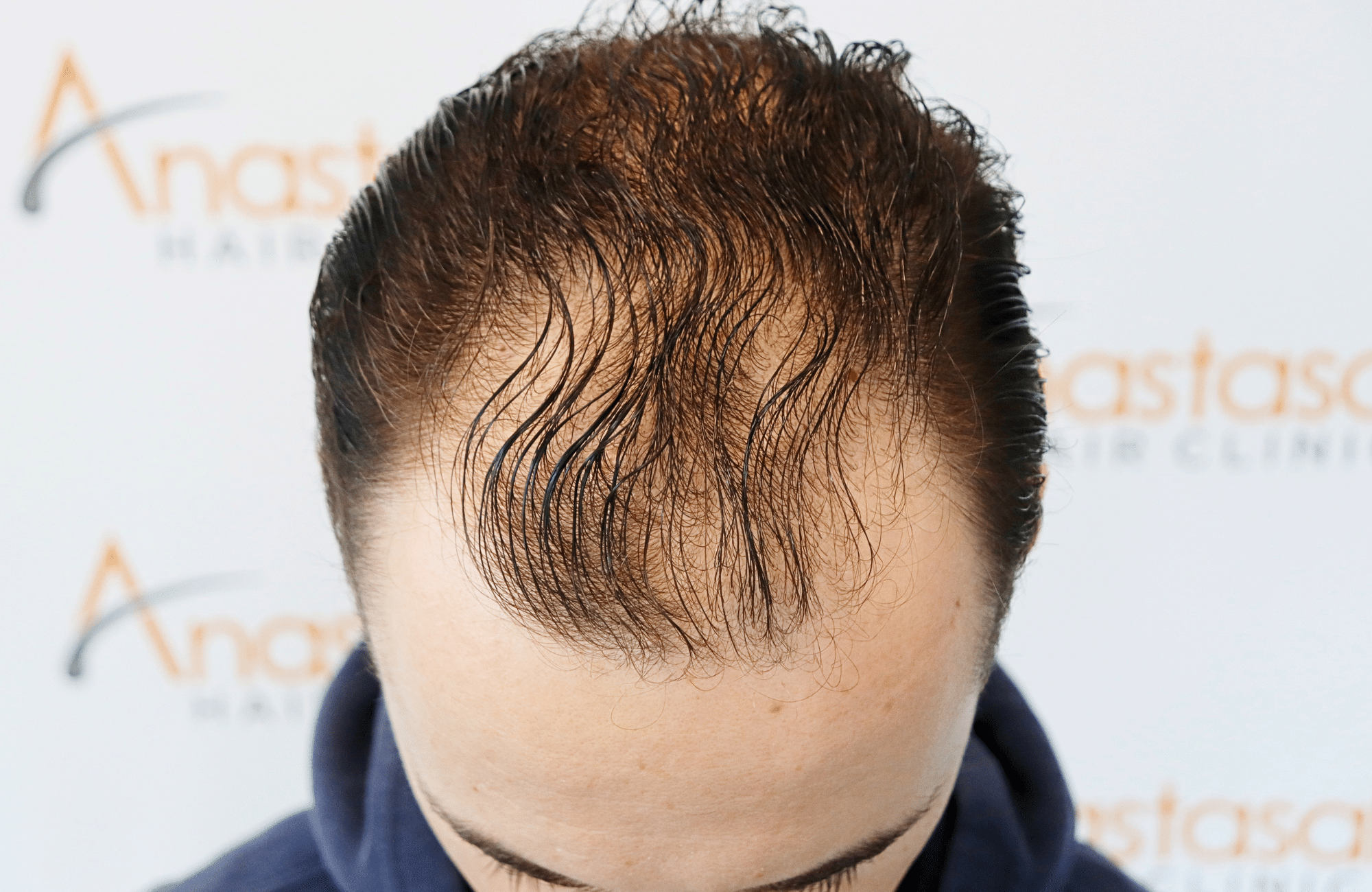 hair transplant result 2500 fus thick (15)