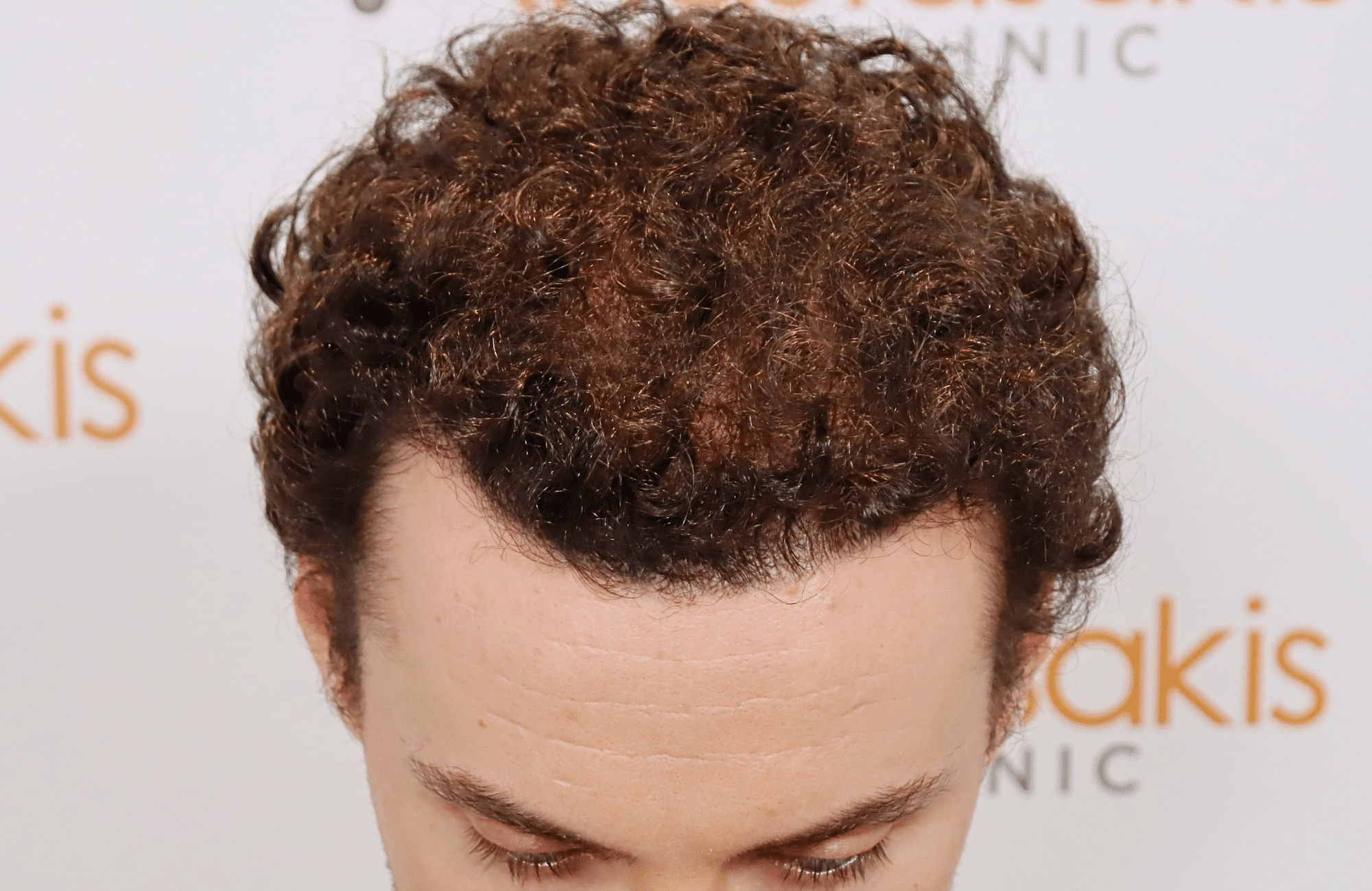 hair transplant result 2500 fus thick (15)