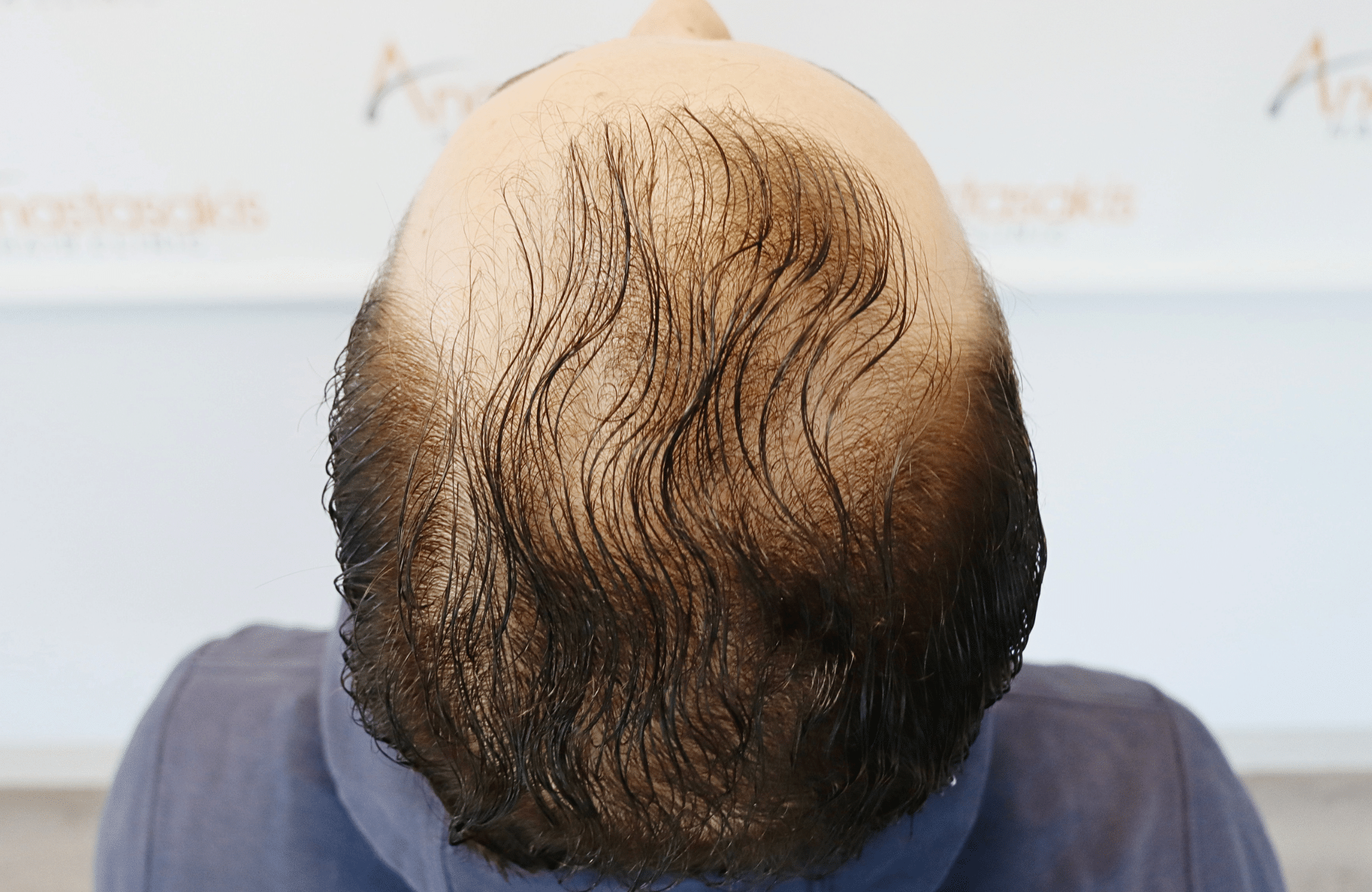 hair transplant result 2500 fus thick (17)