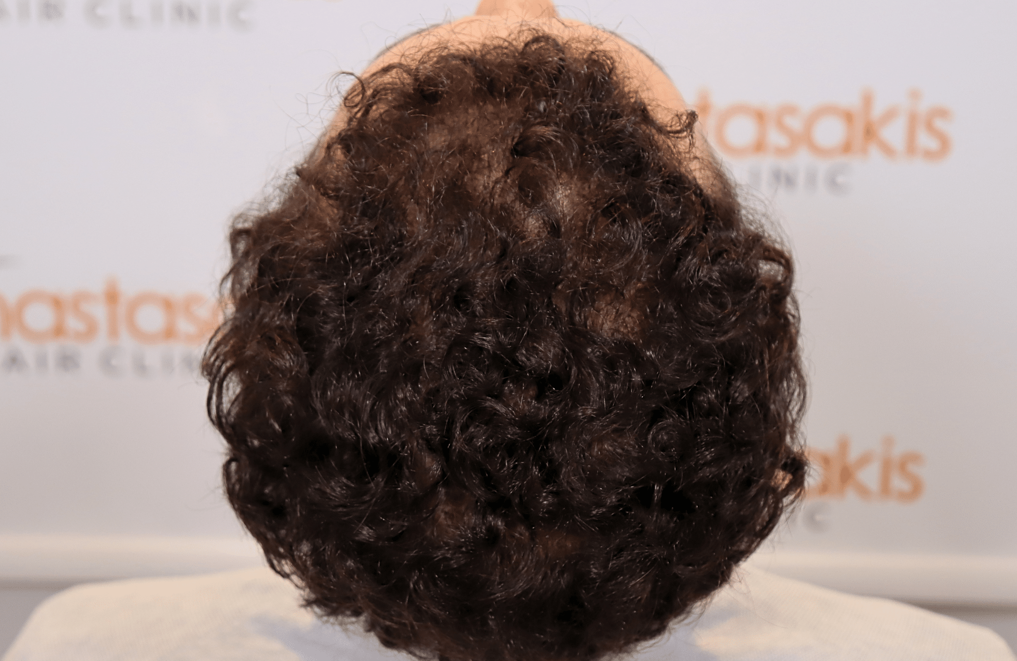 hair transplant result 2500 fus thick (18)