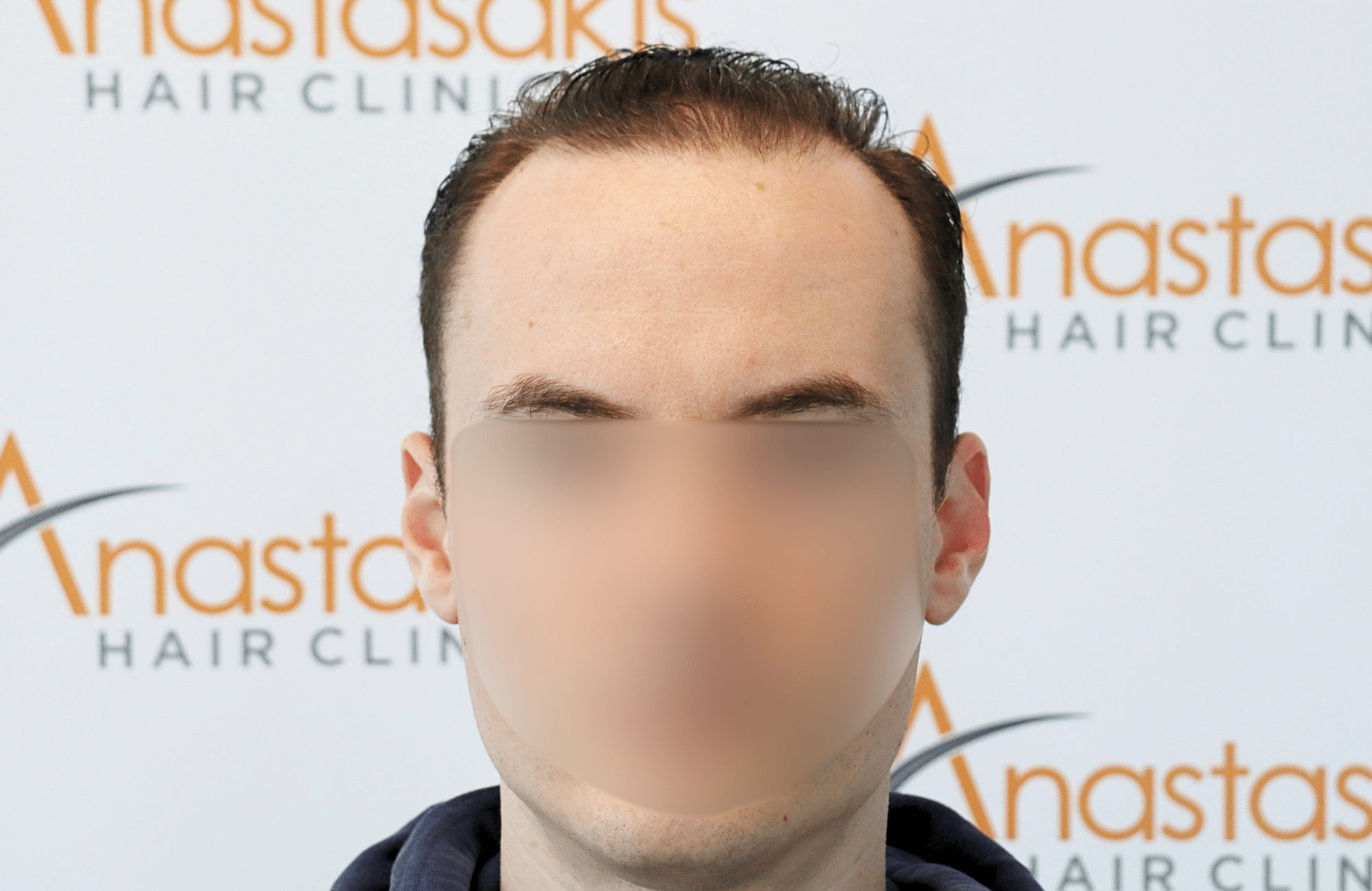 hair transplant result 2500 fus thick (3)