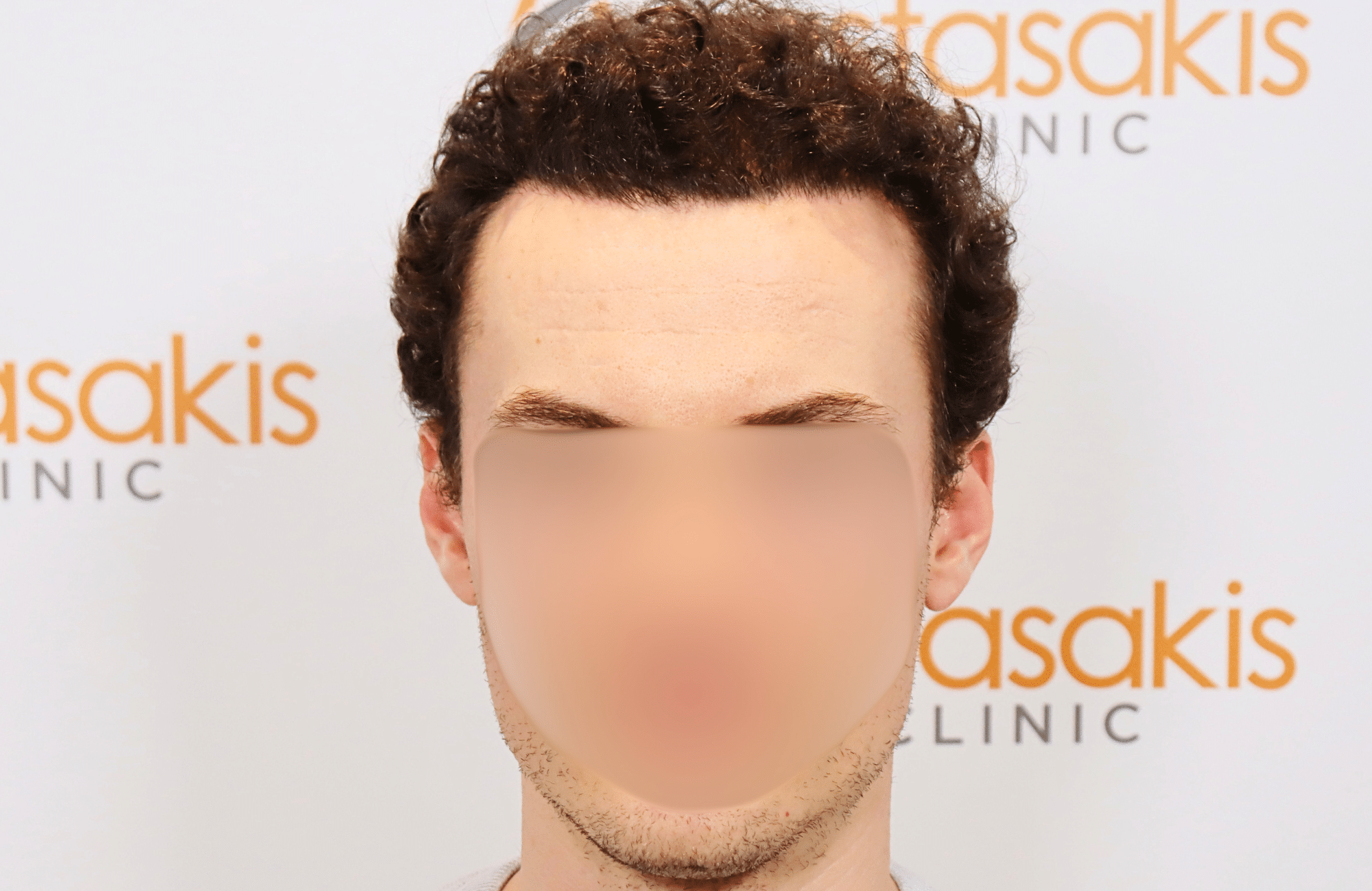 hair transplant result 2500 fus thick (4)