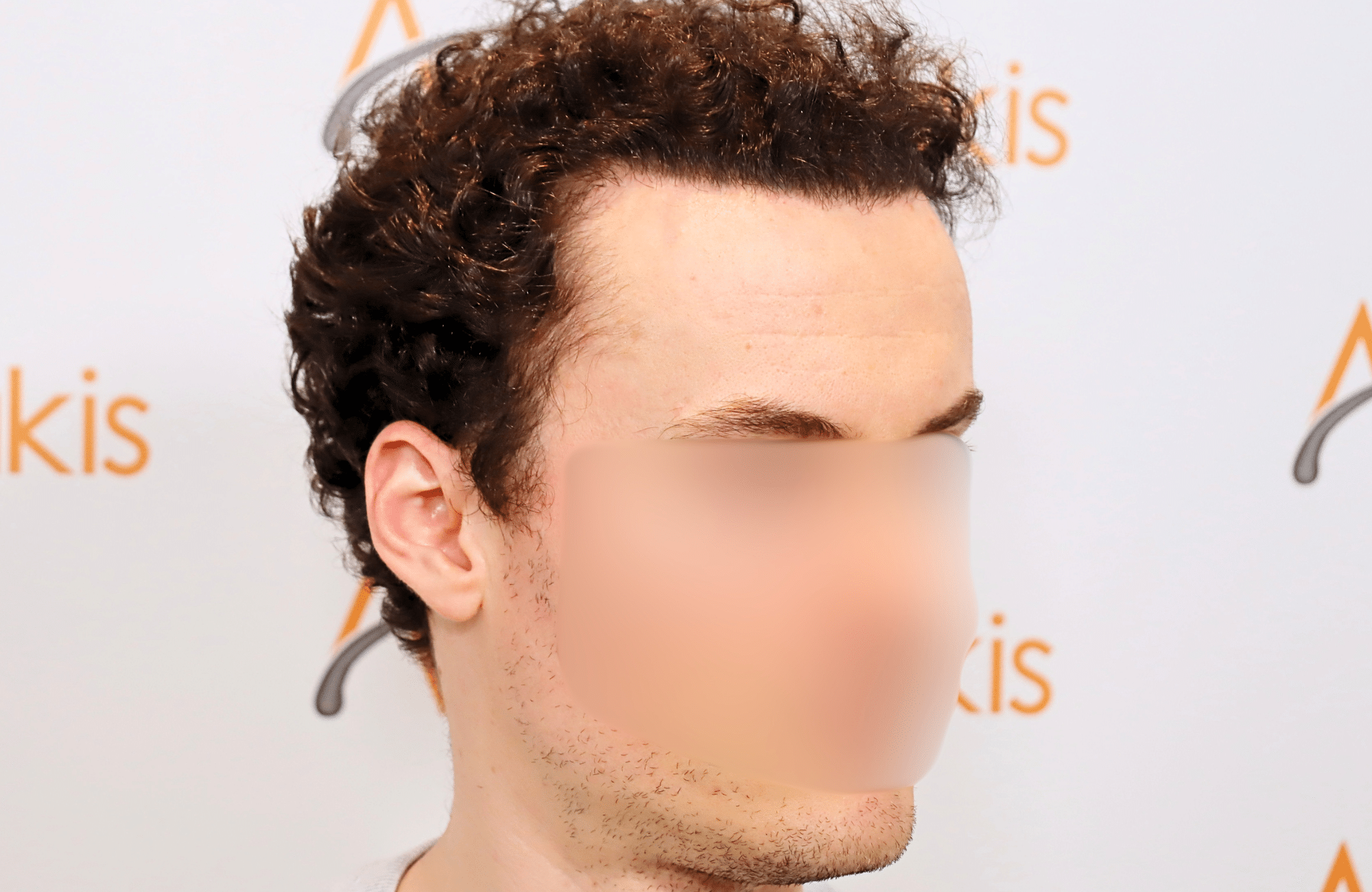hair transplant result 2500 fus thick (6)