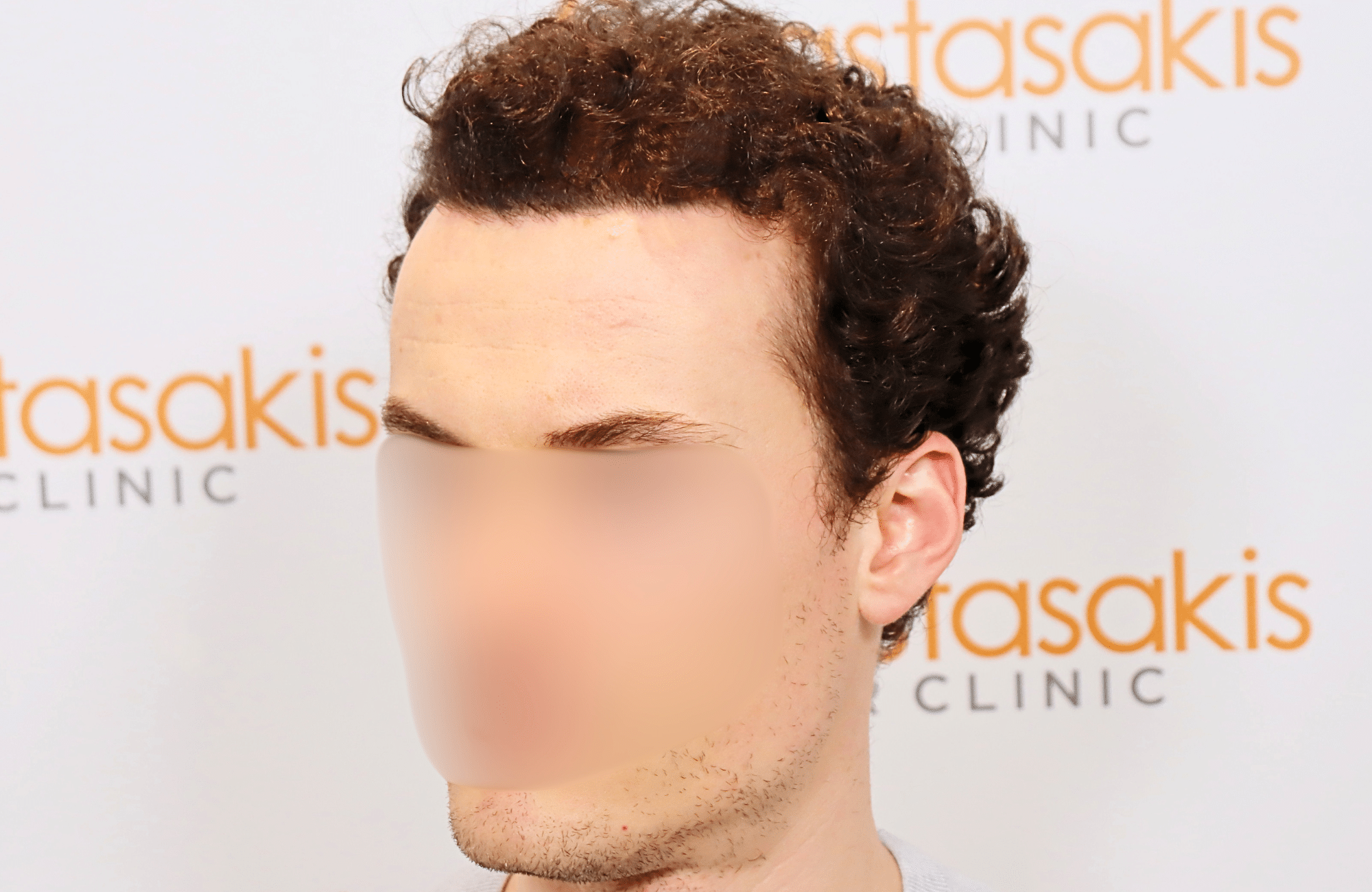 hair transplant result 2500 fus thick (7)
