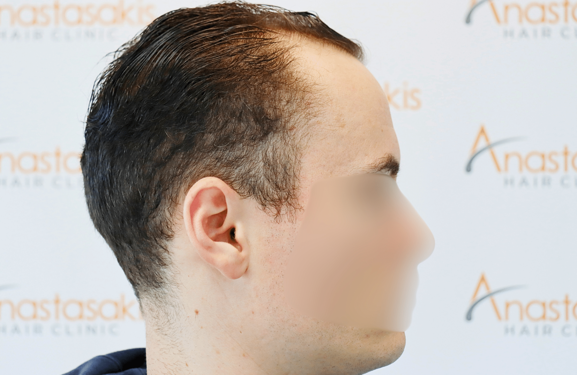 hair transplant result 2500 fus thick (9)