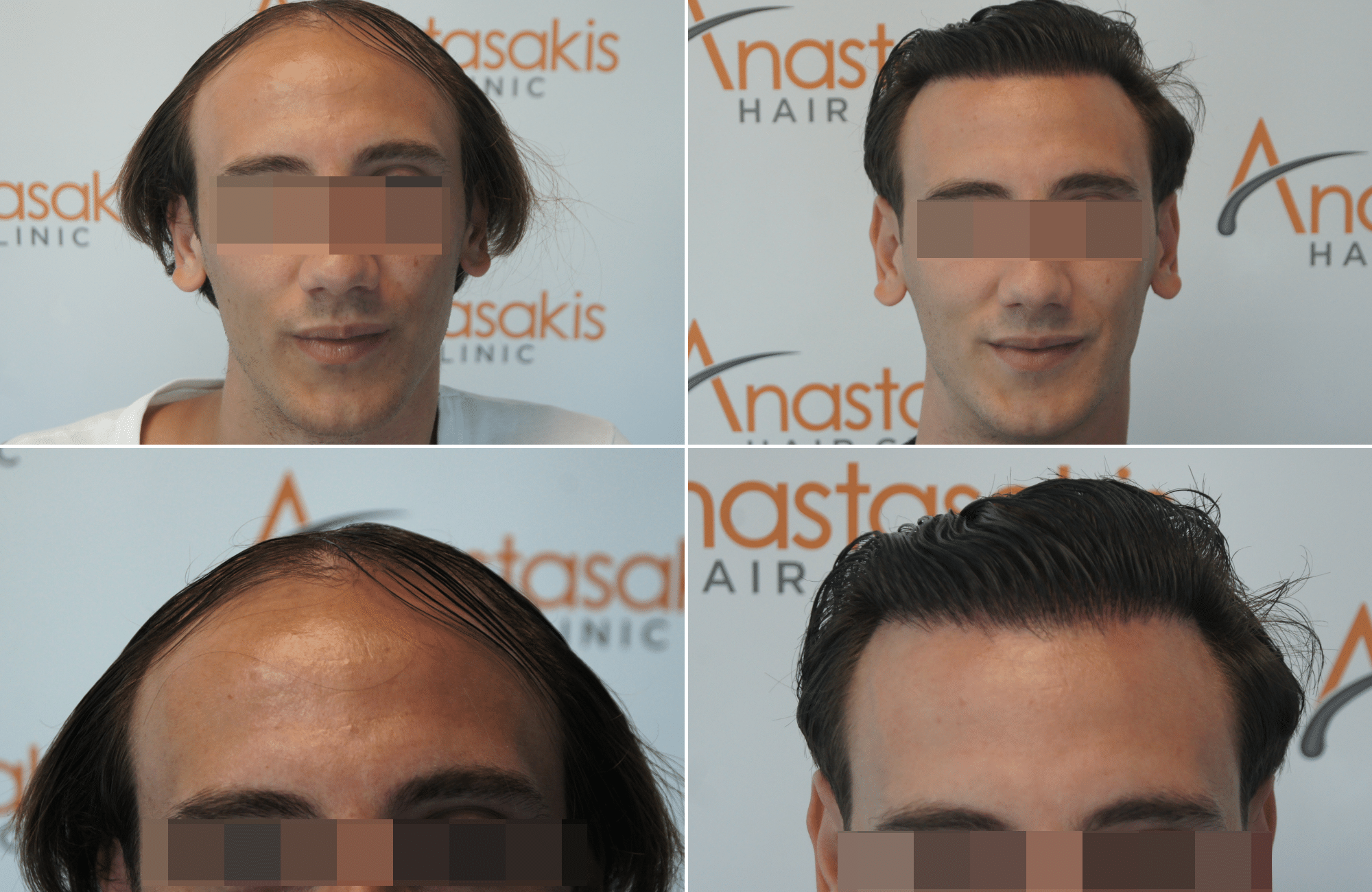 hair transplant result with 2500 follicular units anastasakis hair clinic