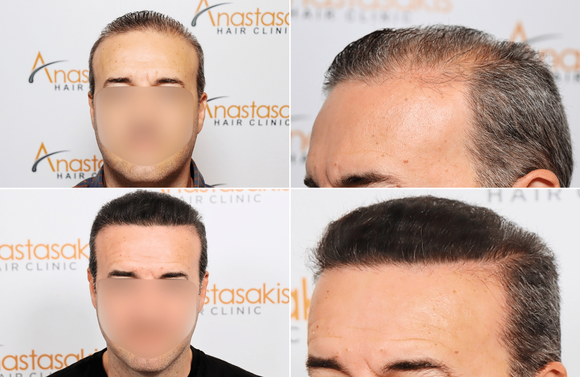 https://www.anastasakishairclinic.gr/portfolio/apotelesma-metamosxefsis-mallion-anastasakis-hair-clinic-602/