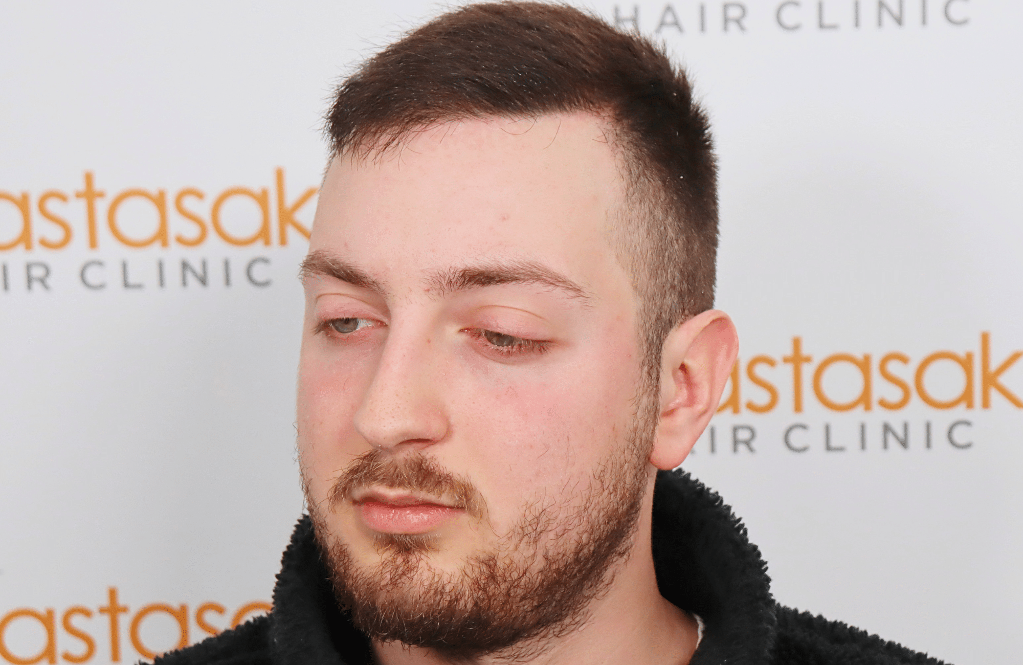 hair transplant result 2600 fus (1)