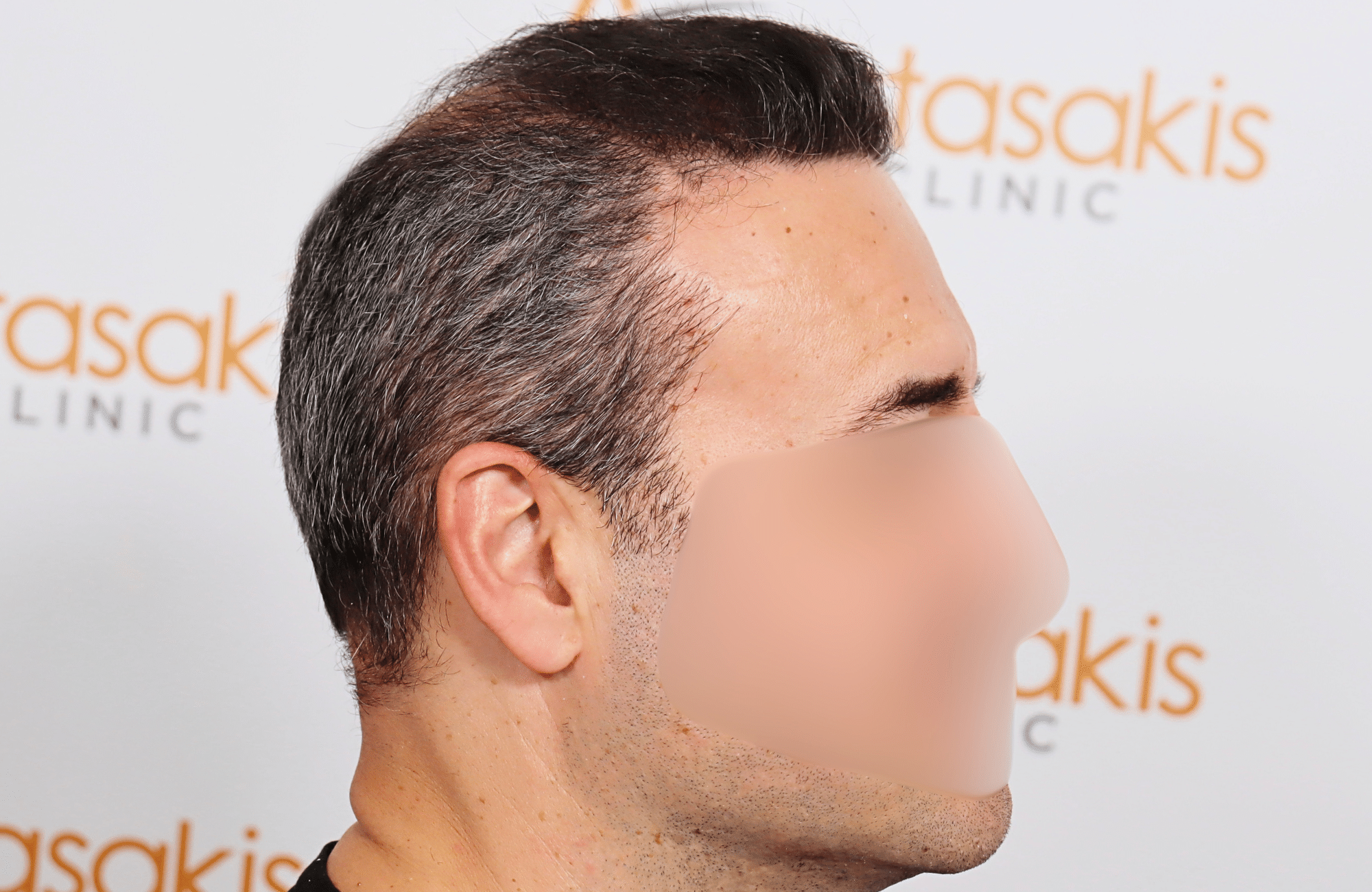 hair transplant result 2600 fus