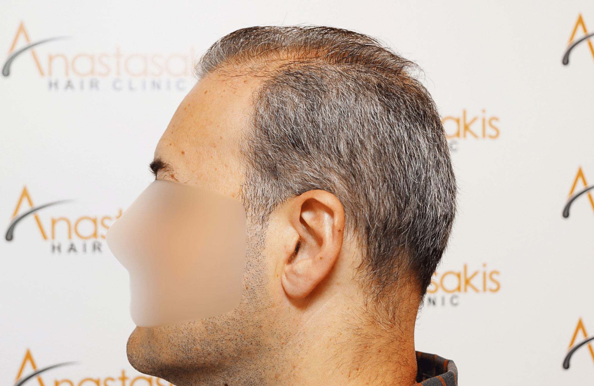 hair transplant result 2600 fus