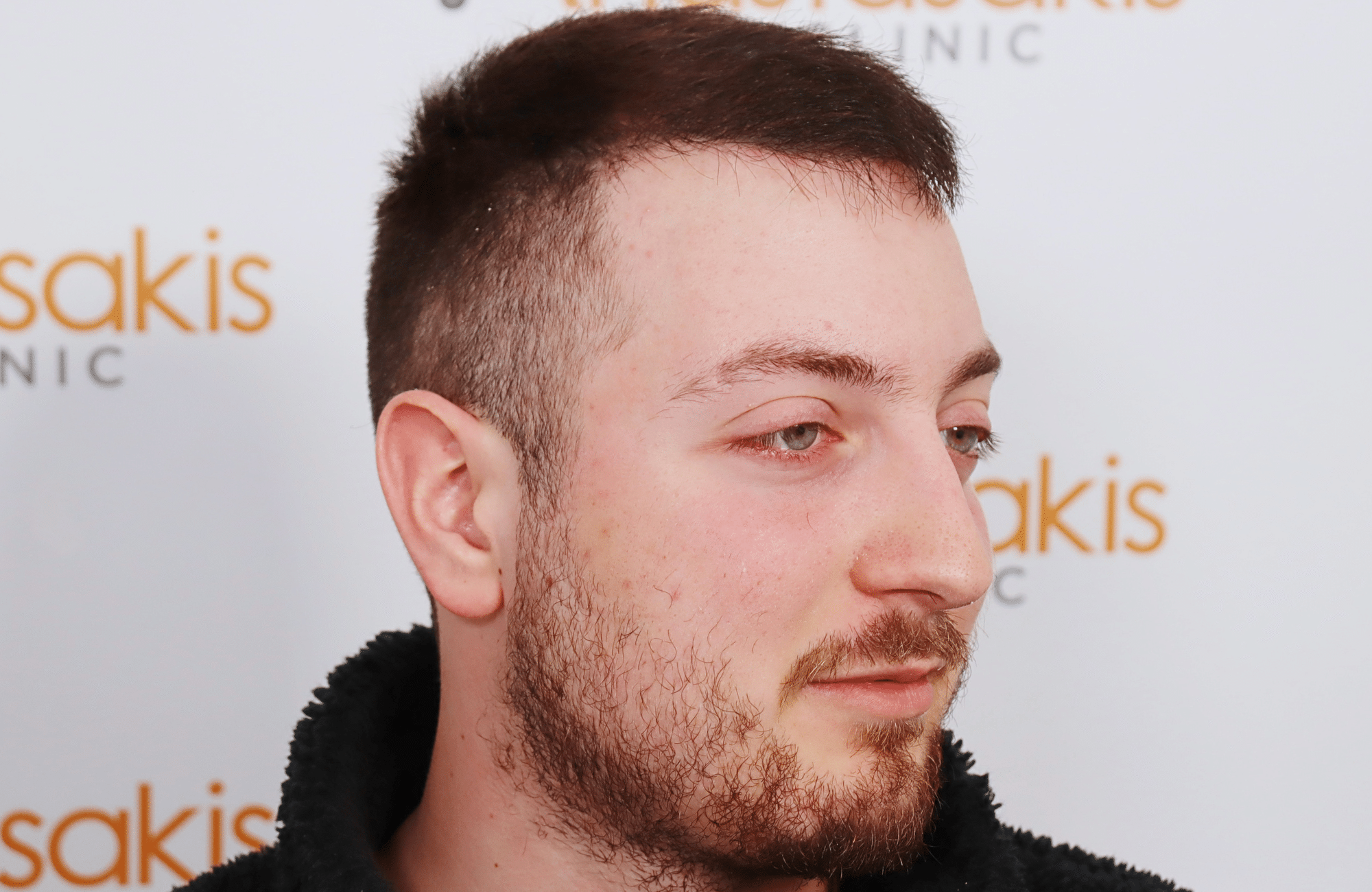 hair transplant result 2600 fus (11)