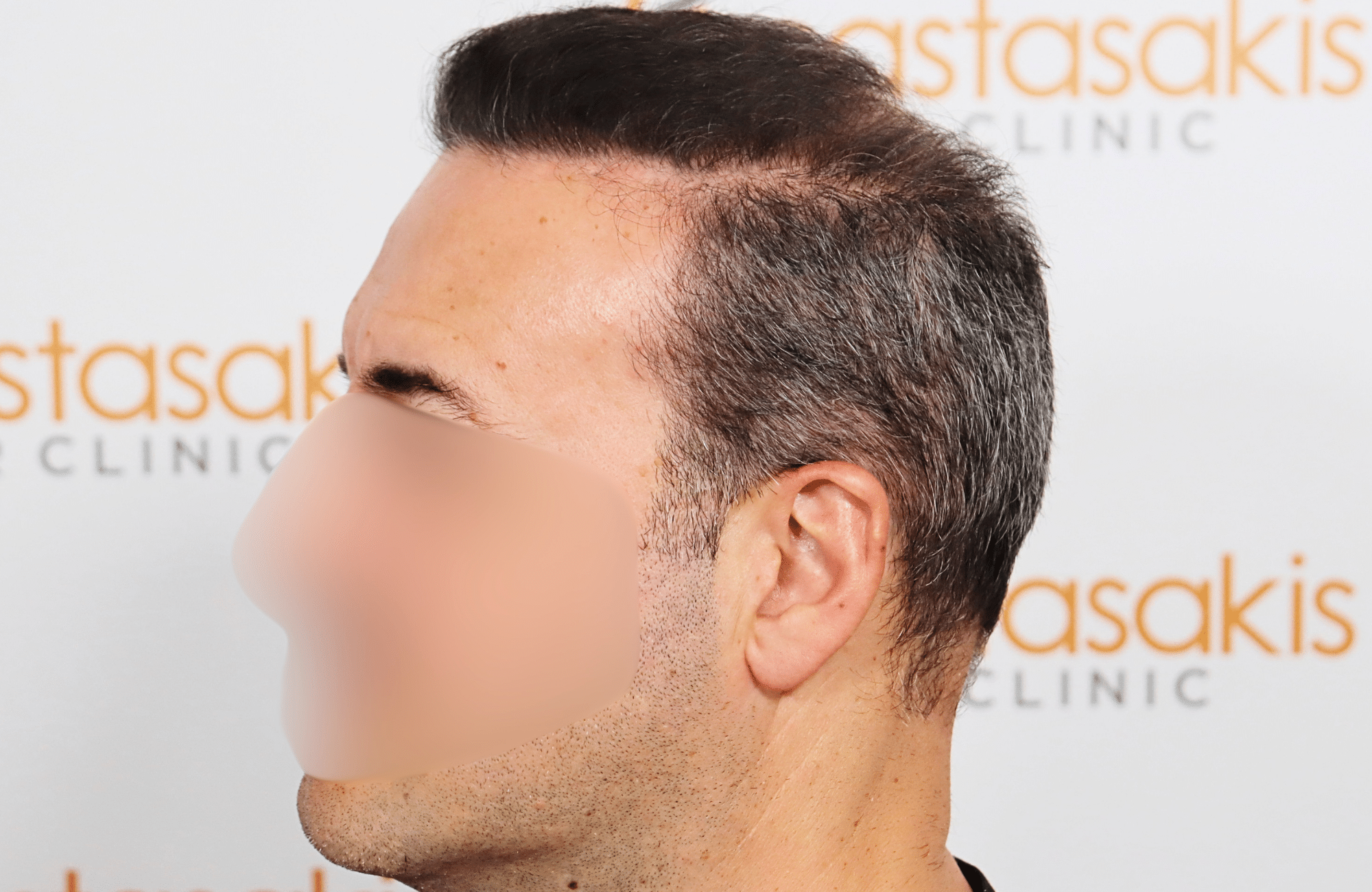 hair transplant result 2600 fus