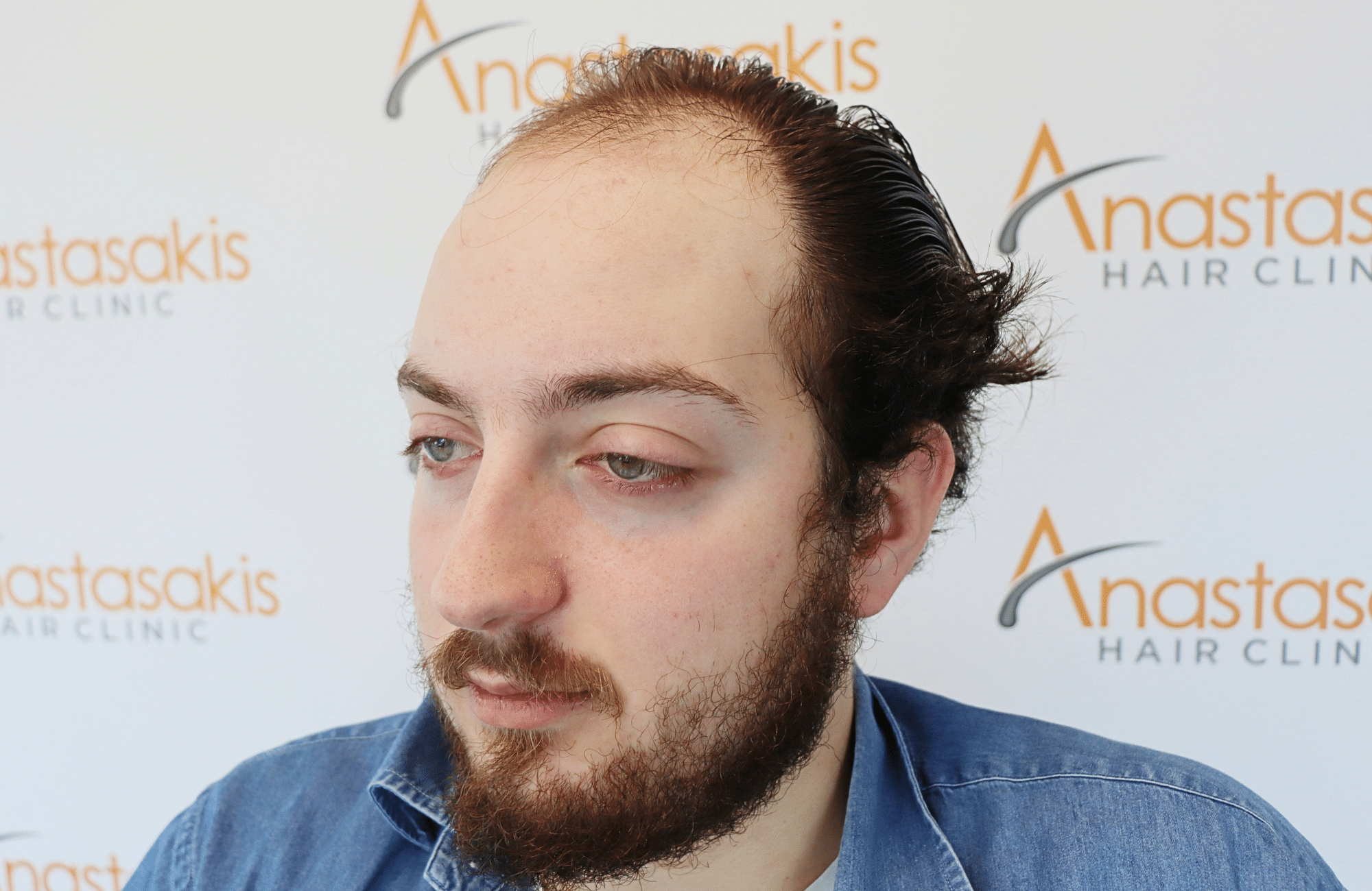 hair transplant result 2600 fus (12)