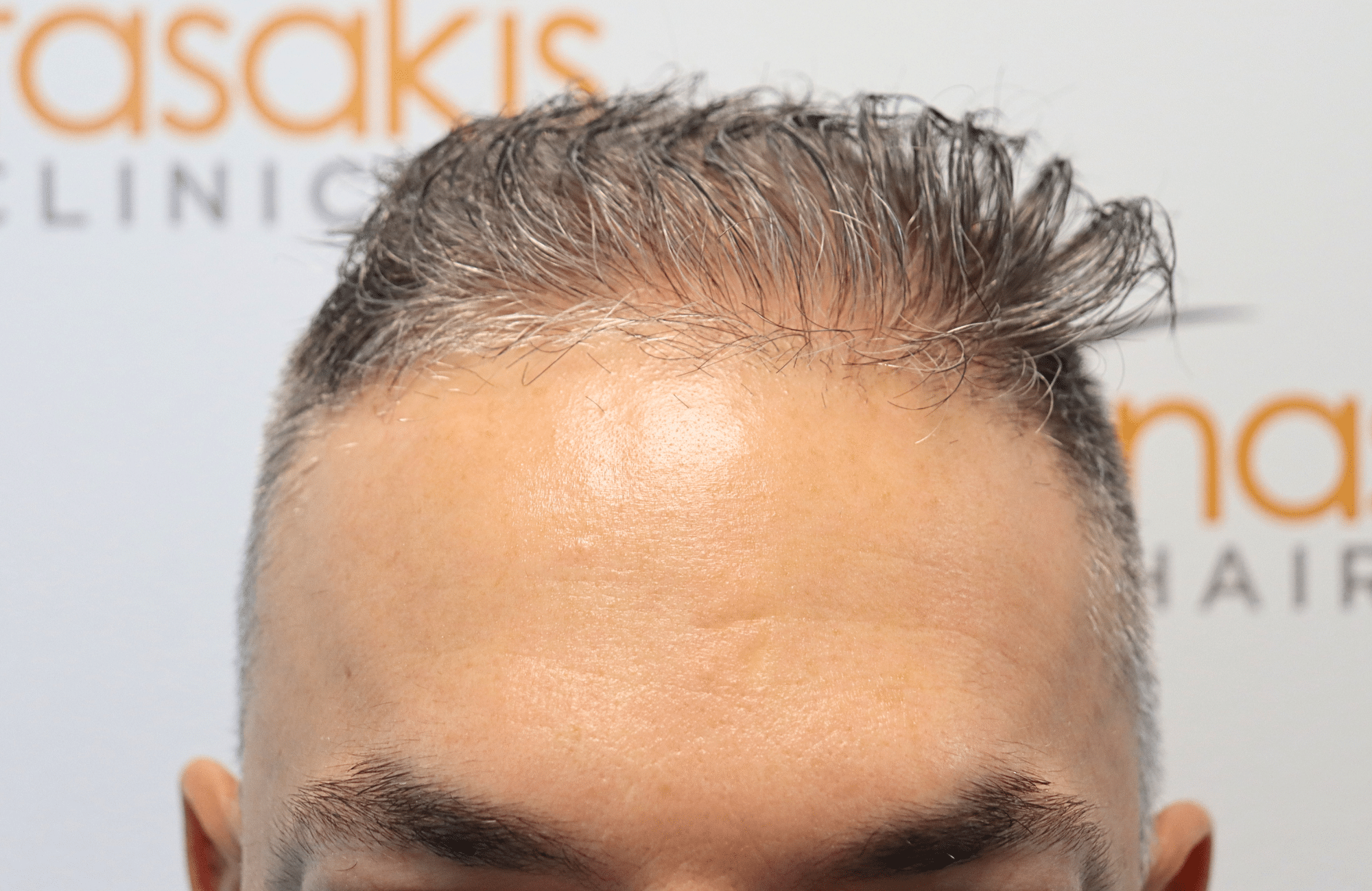hair transplant result 2600 fus