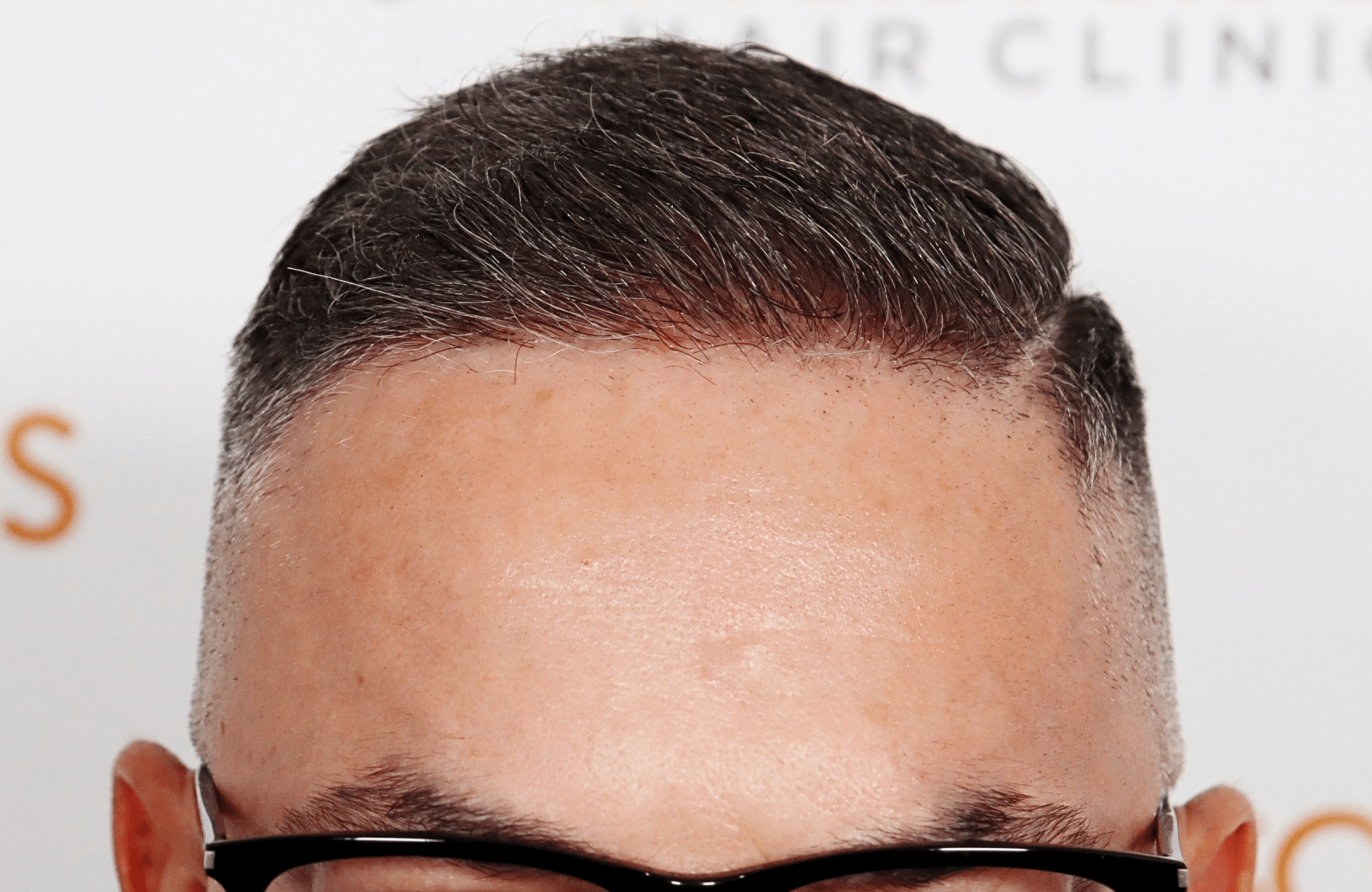 hair transplant result 2600 fus