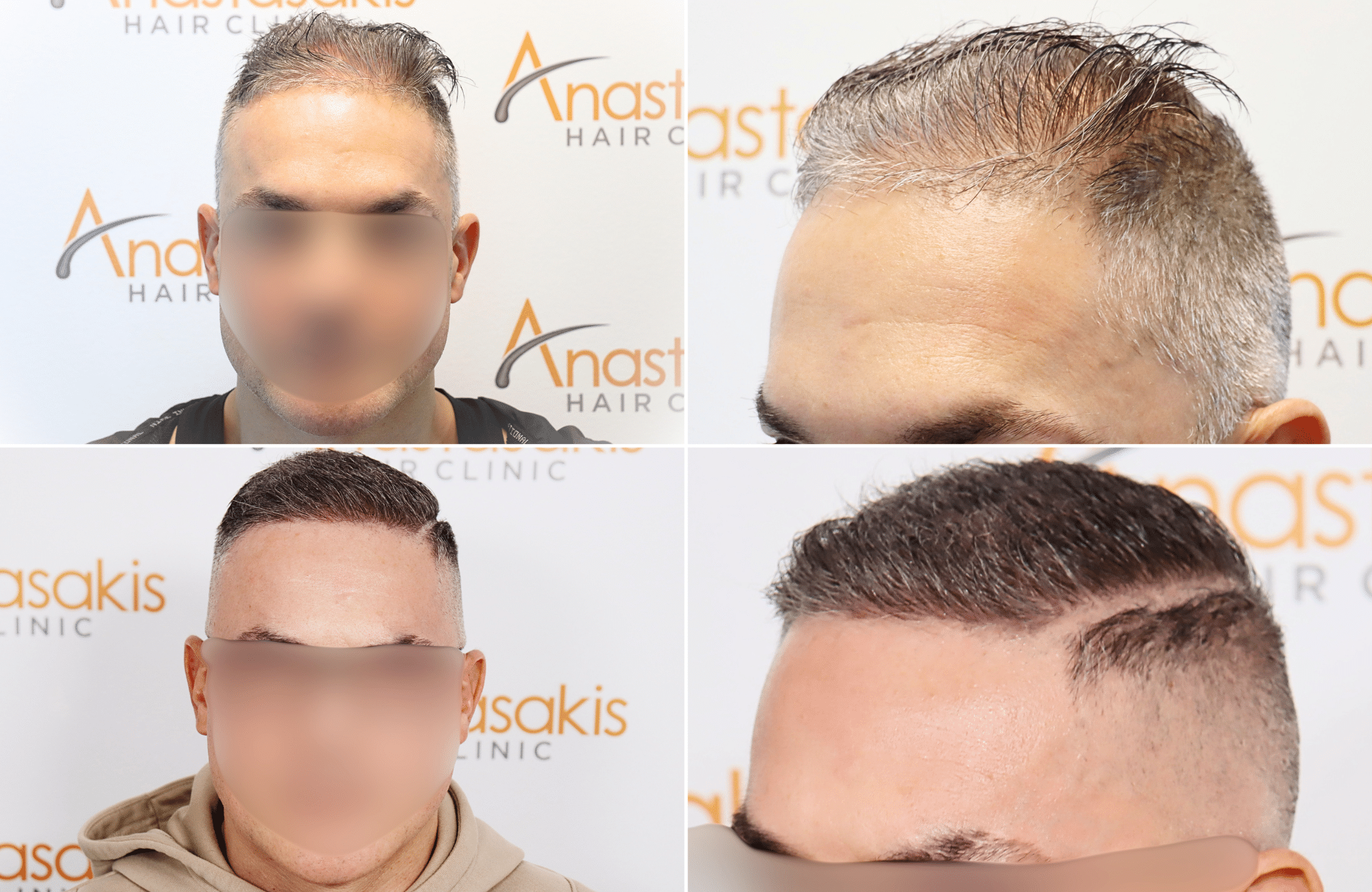 https://www.anastasakishairclinic.gr/portfolio/apotelesma-metamosxefsis-mallion-anastasakis-hair-clinic-239/