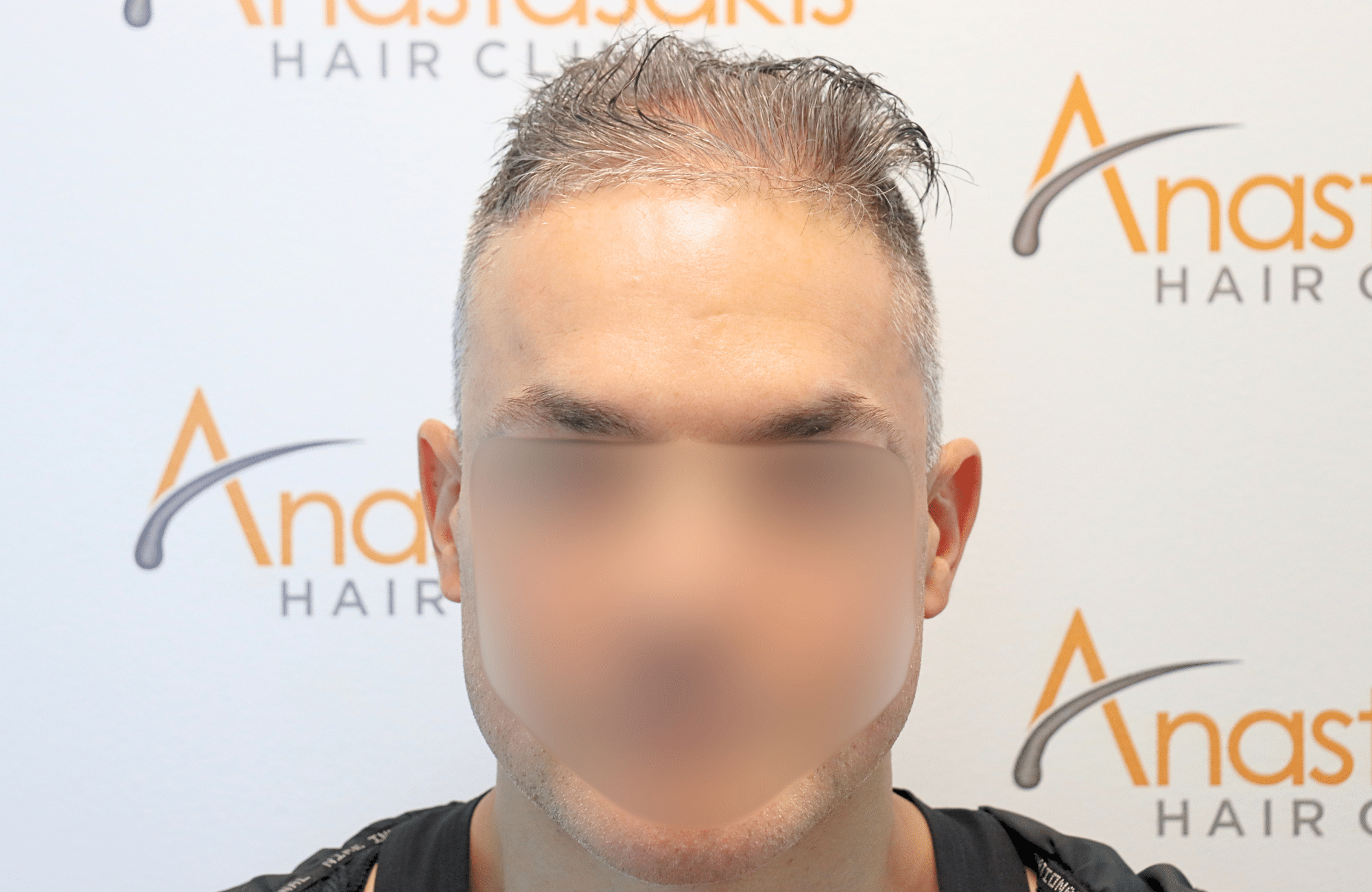 hair transplant result 2600 fus