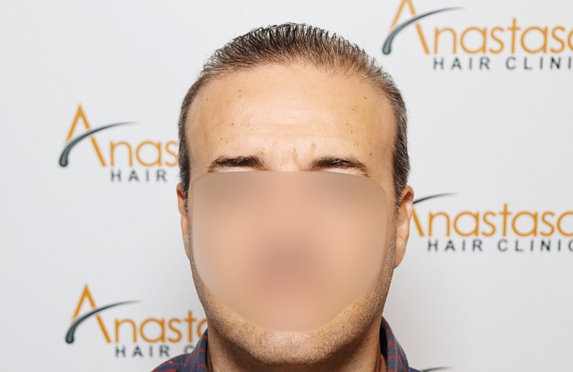 hair transplant result 2600 fus