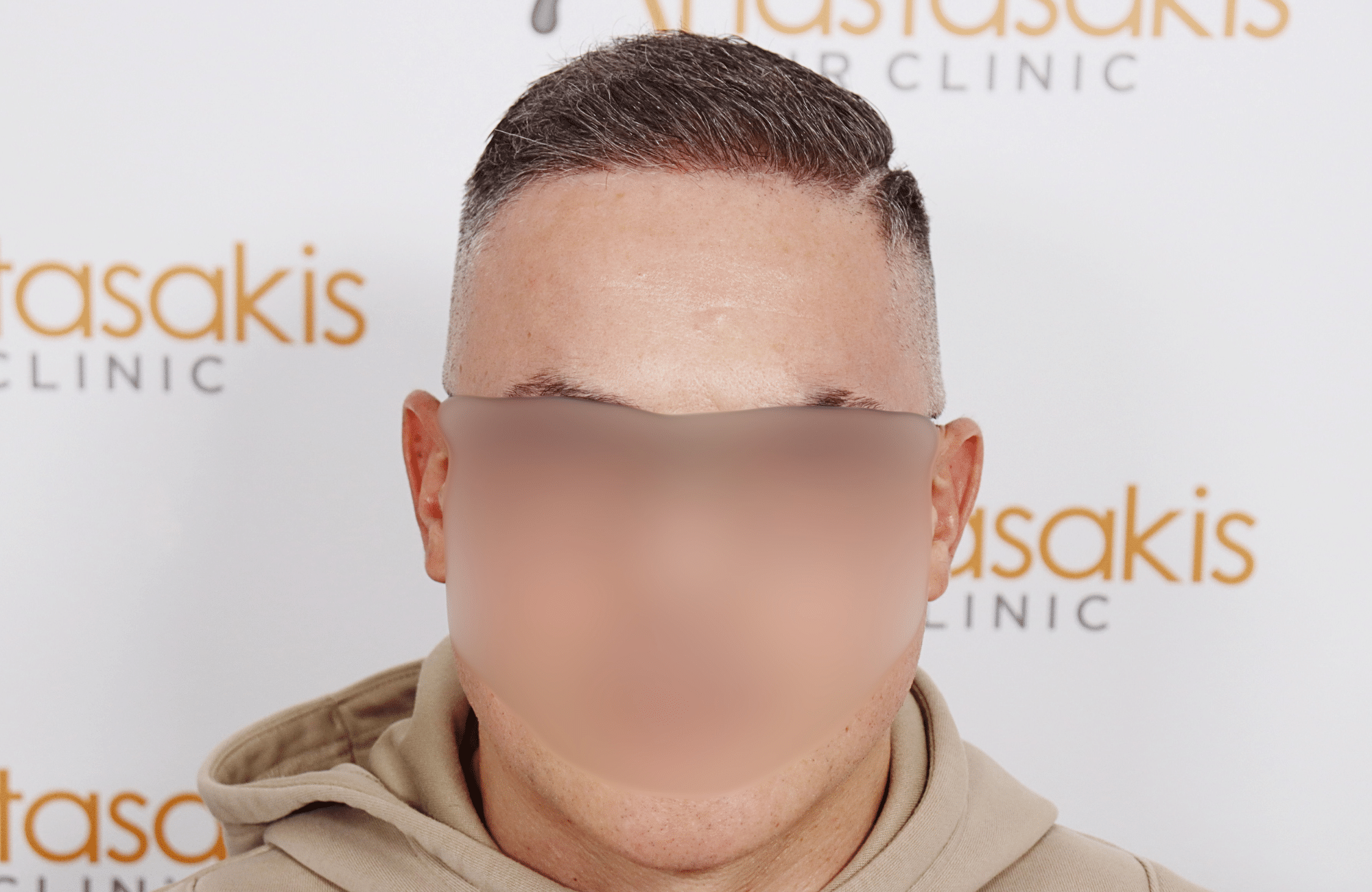 hair transplant result 2600 fus