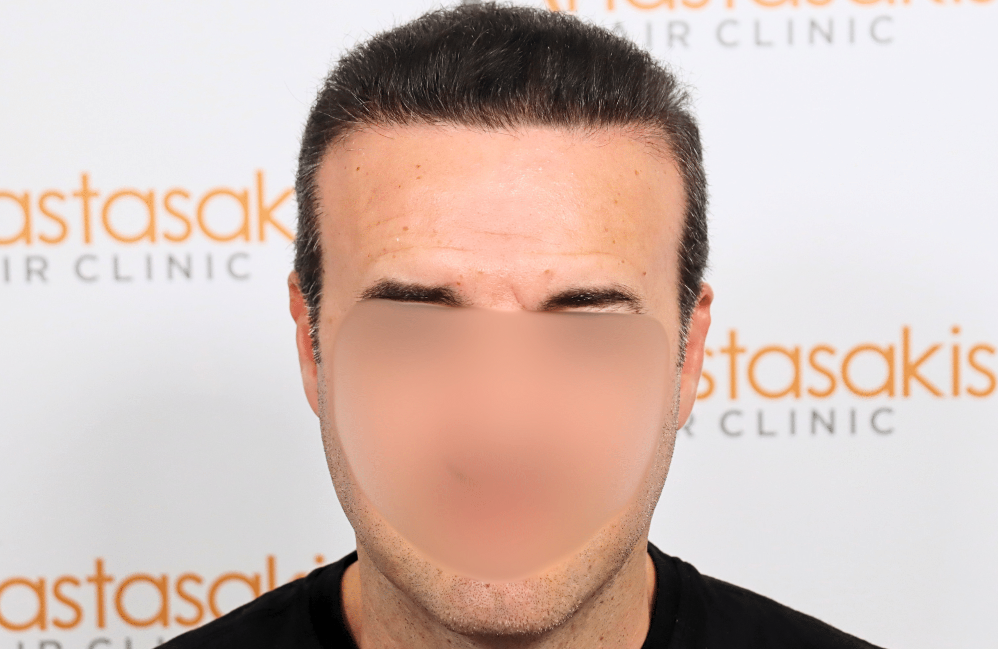 hair transplant result 2600 fus