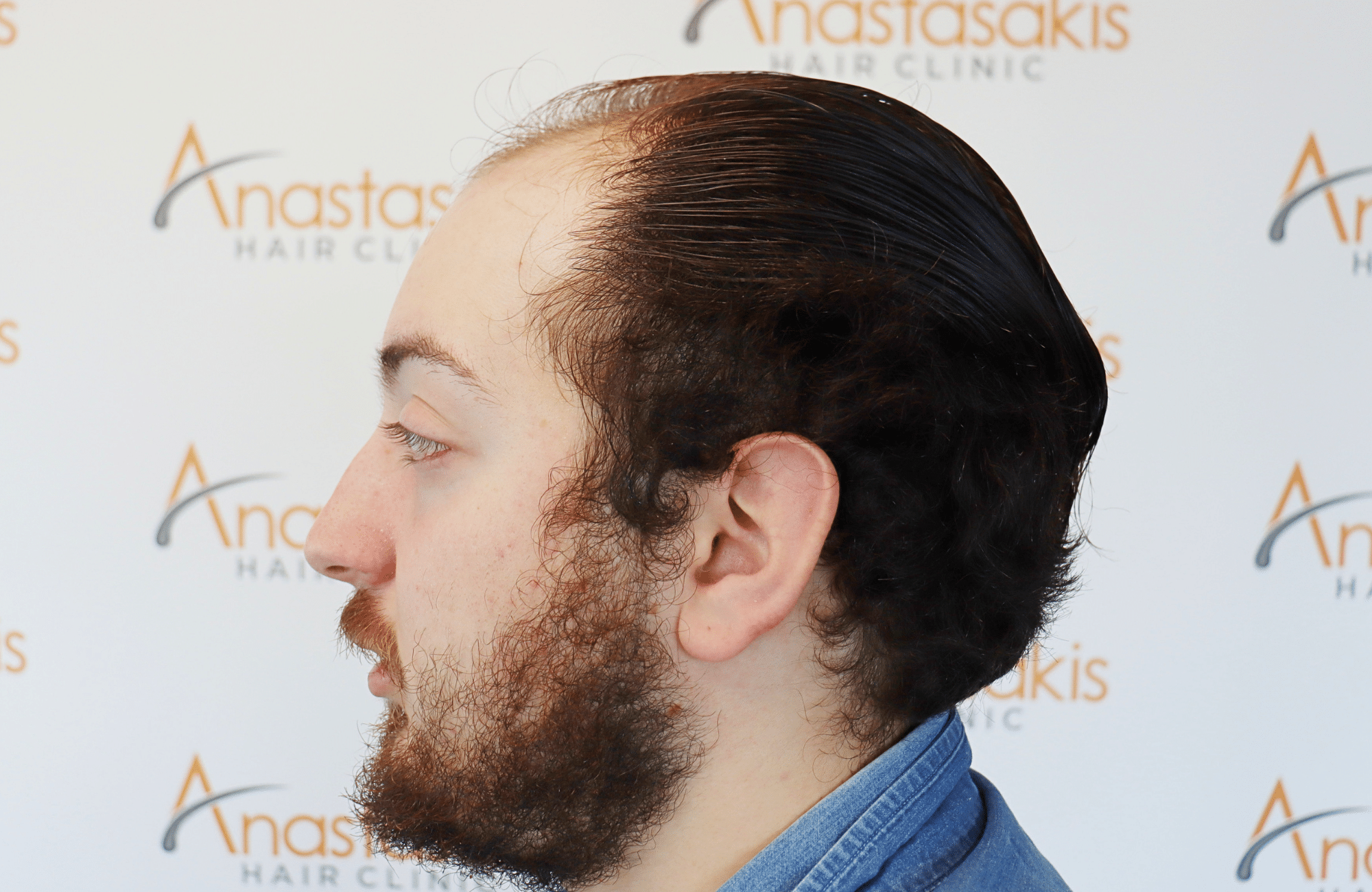 hair transplant result 2600 fus (4)