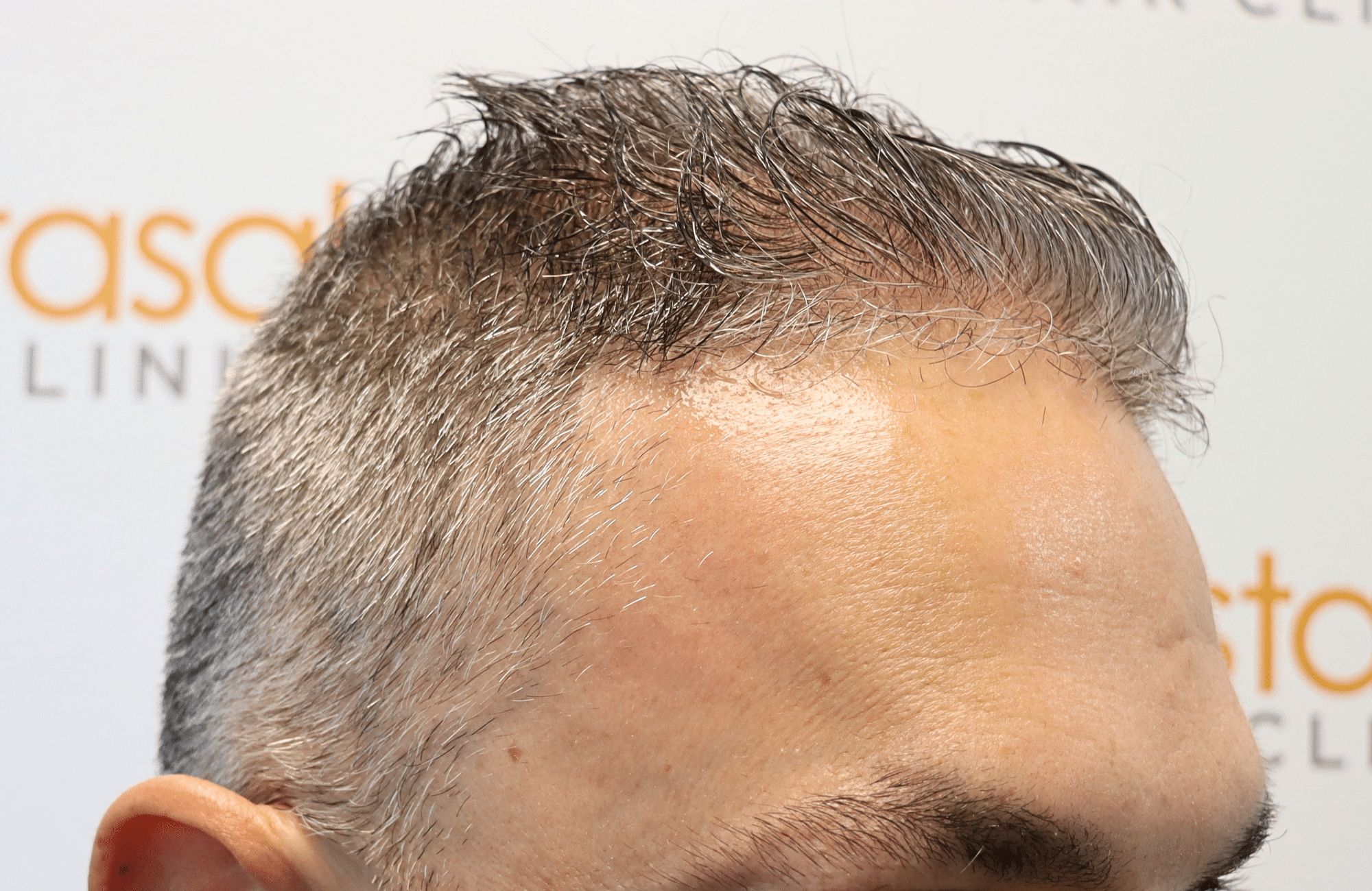hair transplant result 2600 fus
