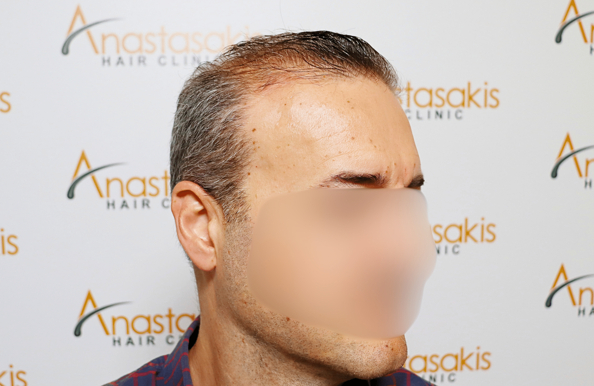 hair transplant result 2600 fus