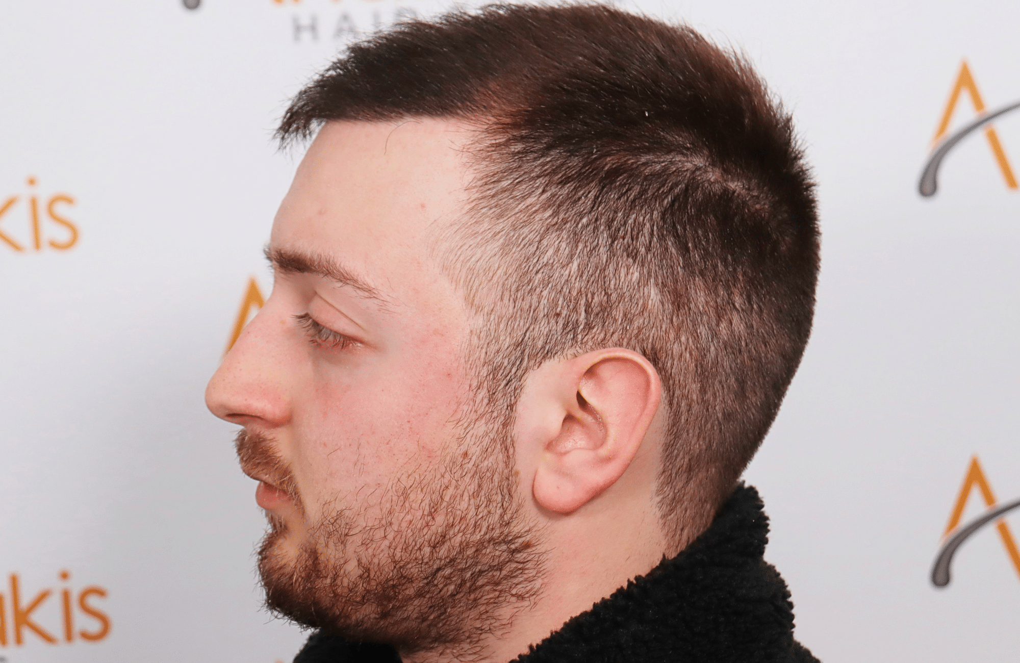 hair transplant result 2600 fus (5)