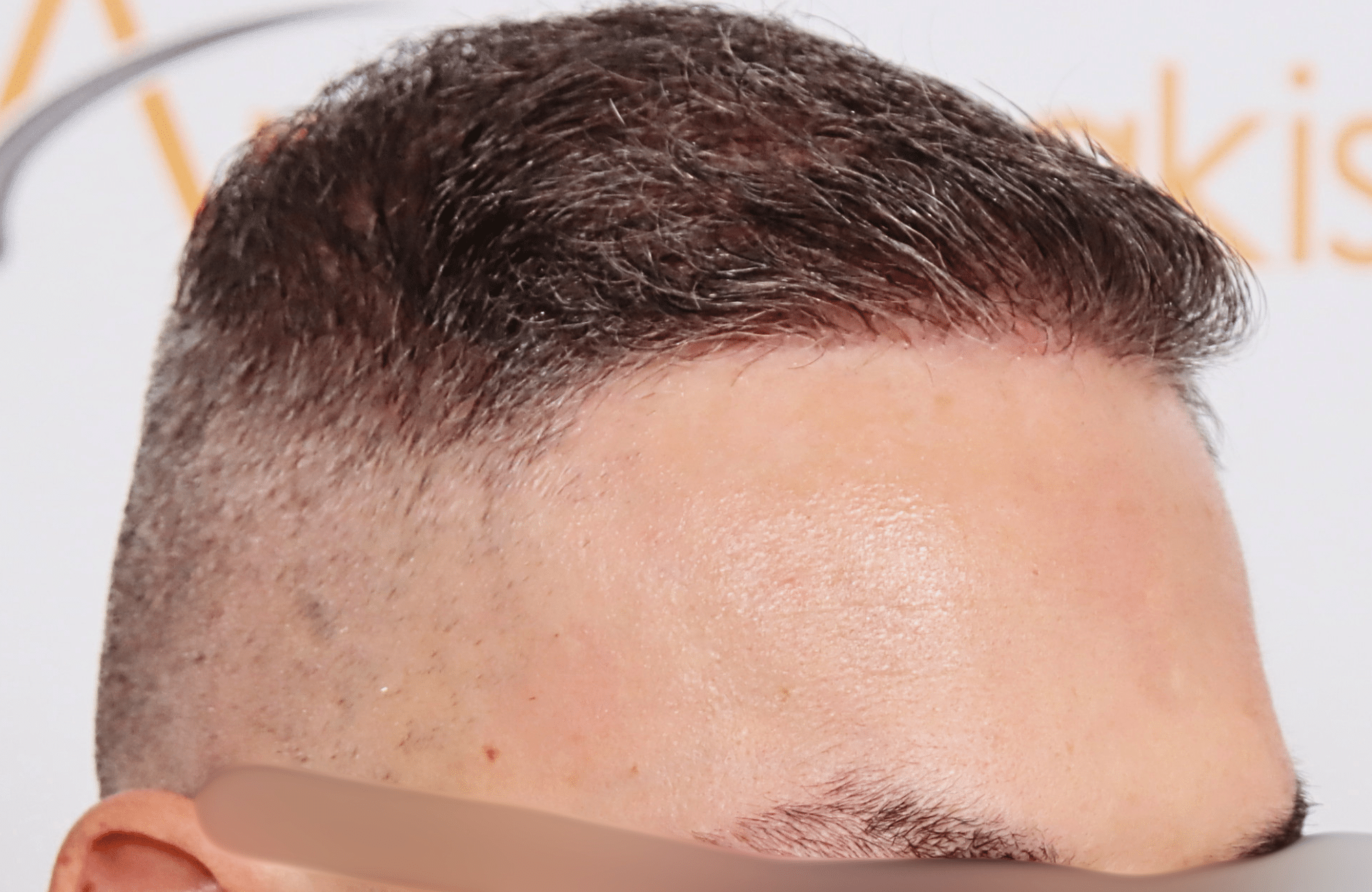 hair transplant result 2600 fus