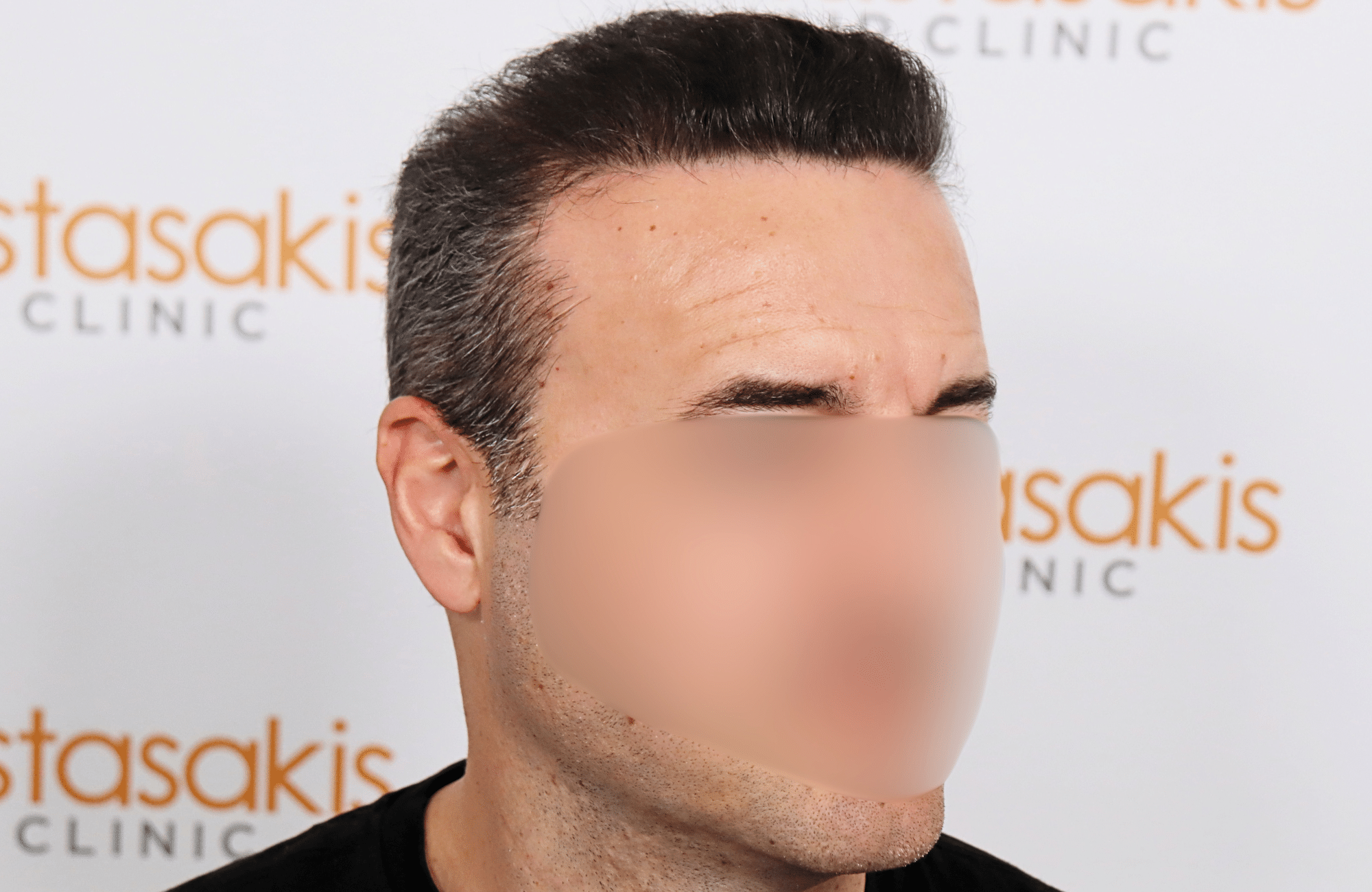 hair transplant result 2600 fus