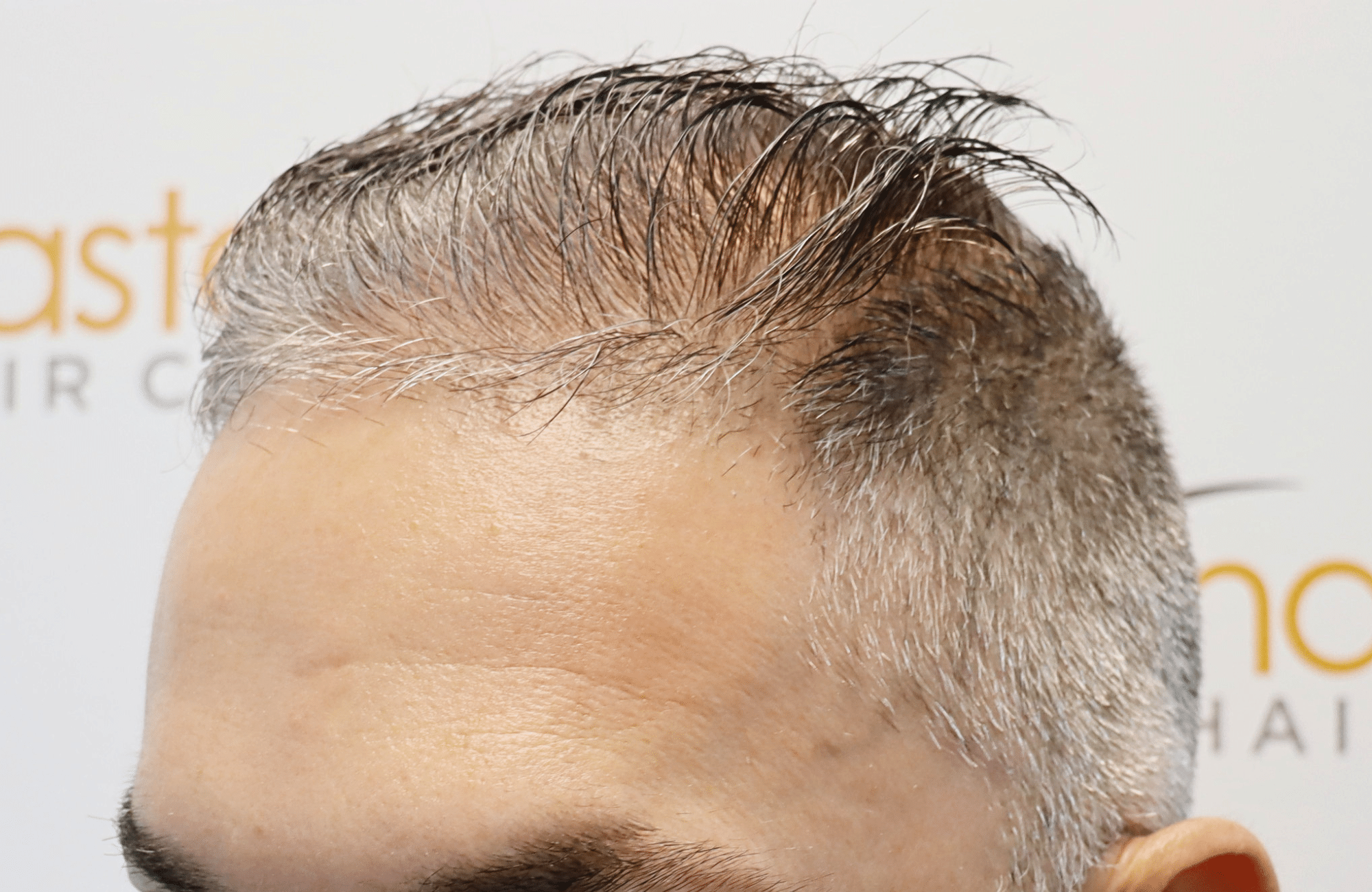 hair transplant result 2600 fus
