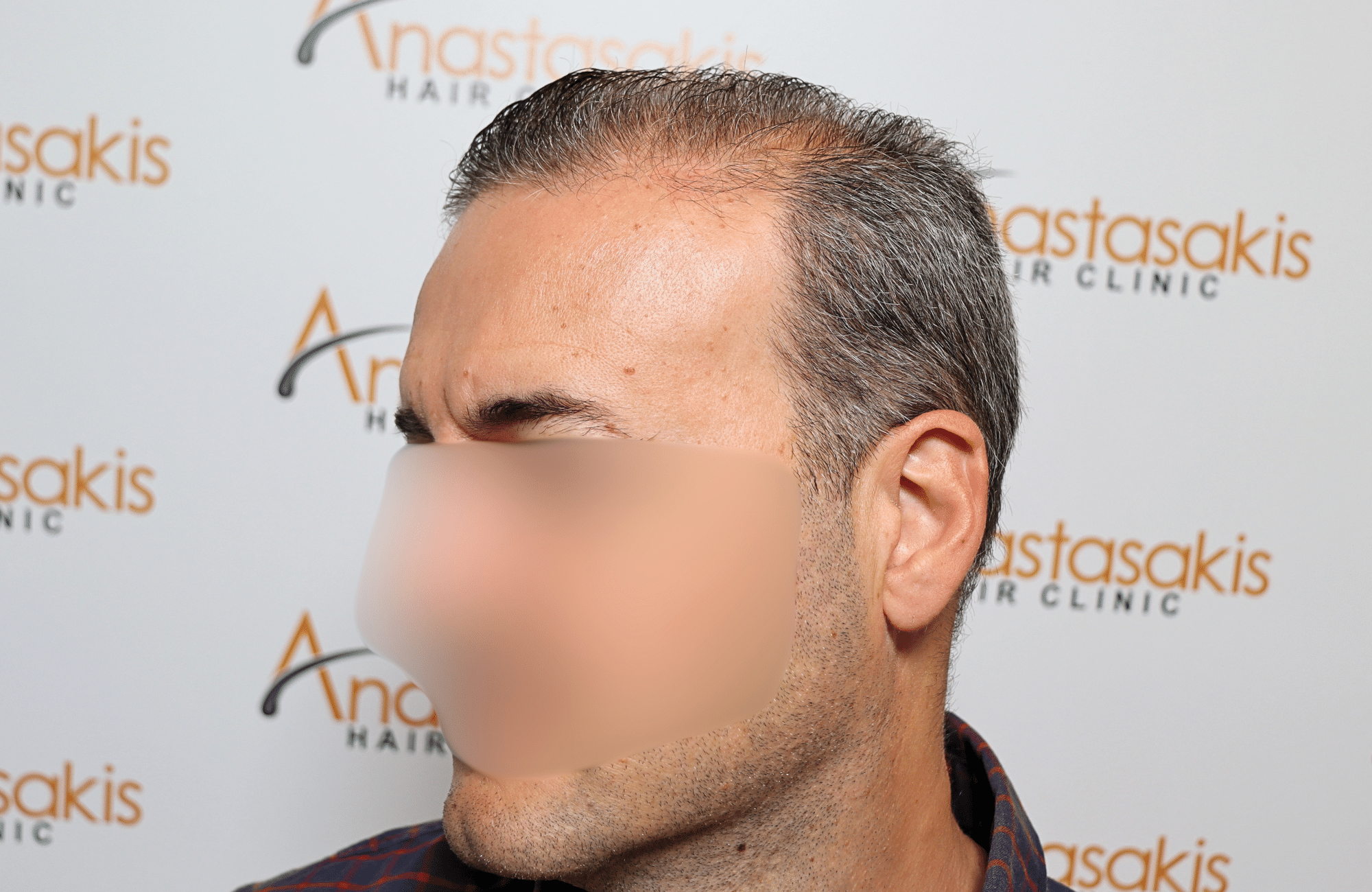 hair transplant result 2600 fus