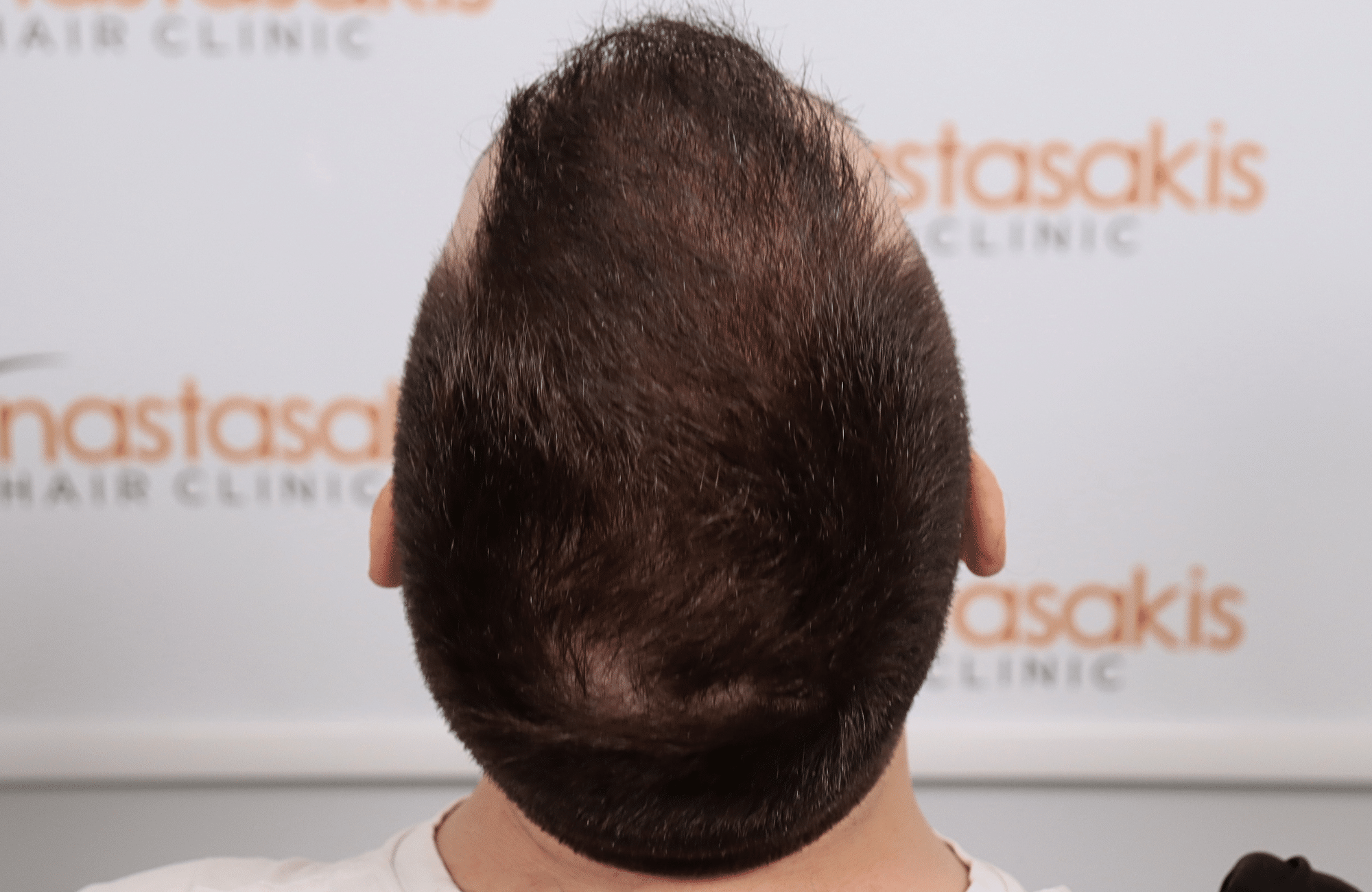 hair transplant result 2600 fus (7)